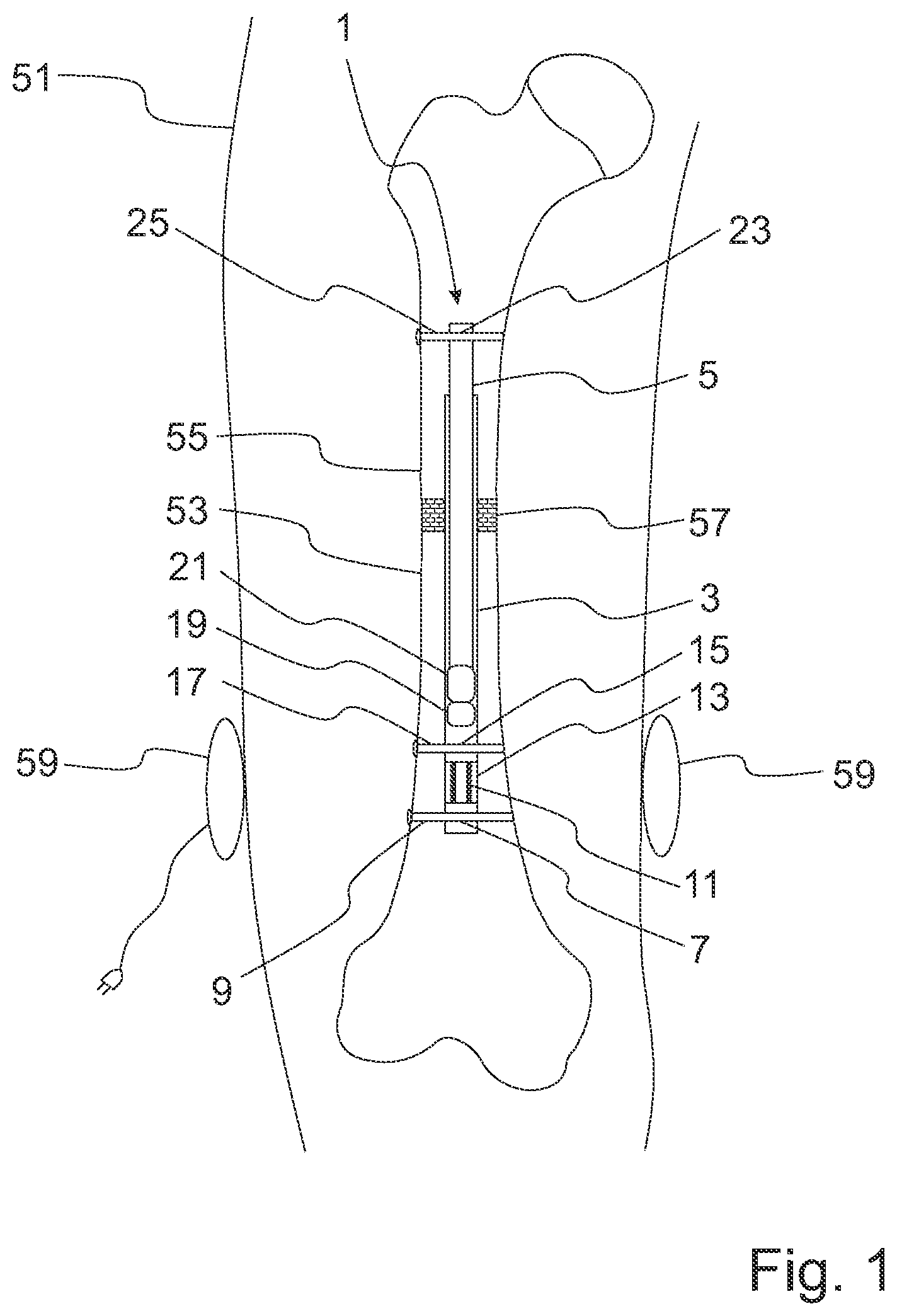 Patent US12324612 — Intramedullary nail for distracting a long bone — Figure 1