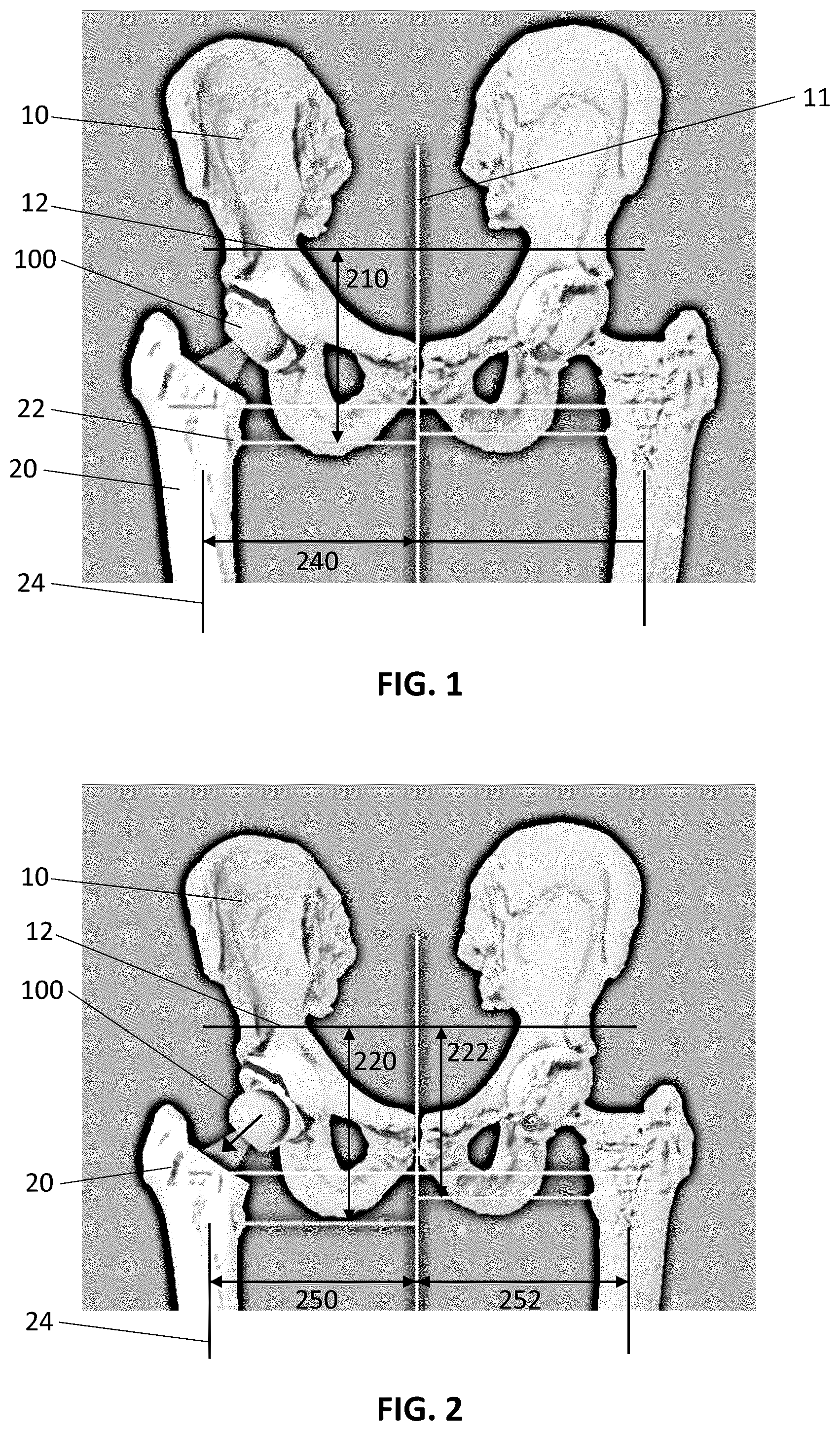 Patent US12324615 — Assessment of soft tissue tension in hip procedures — Figure 1
