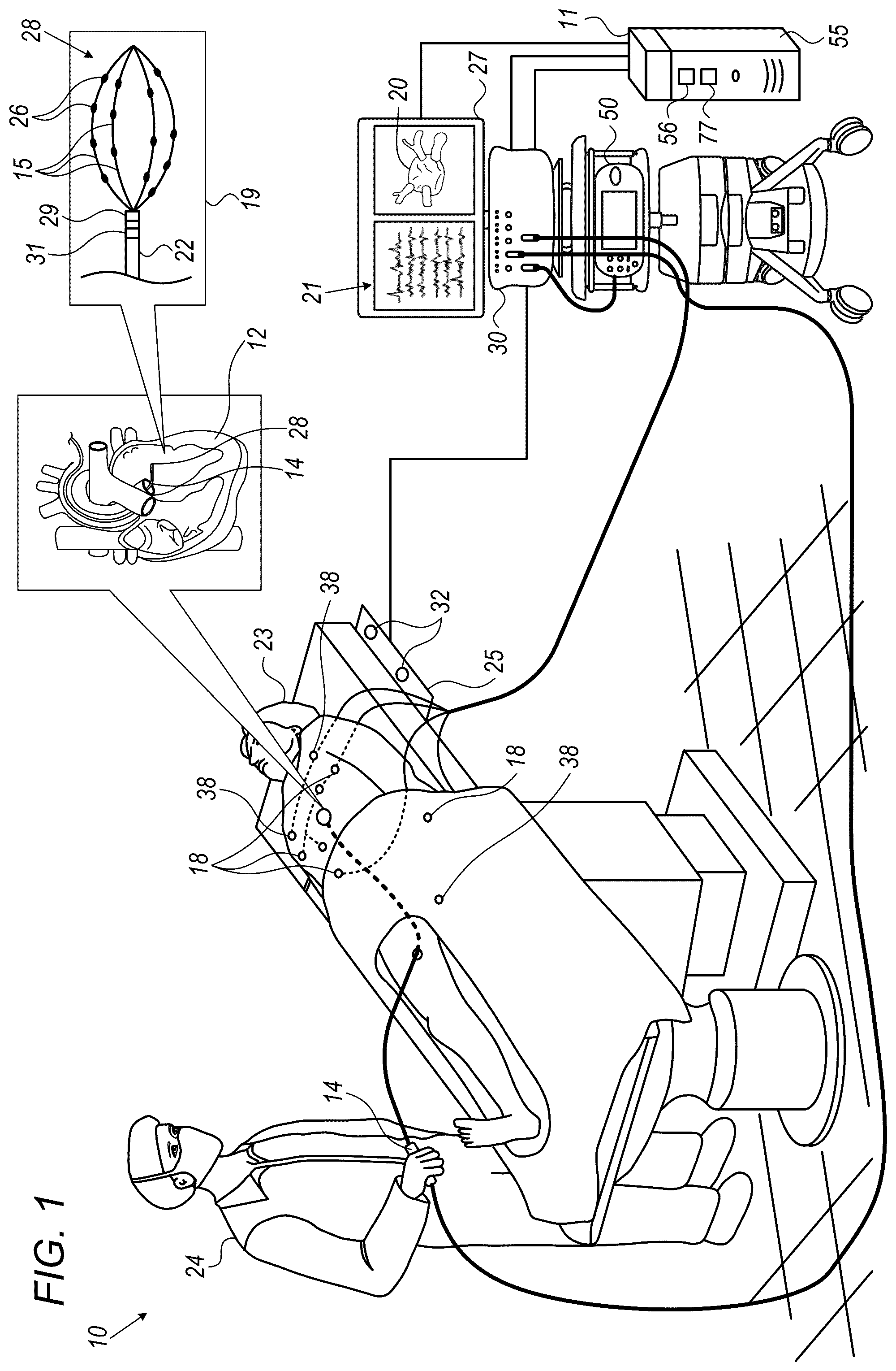 Patent US12324669 — Detecting local activation source in atrial fibrillation — Figure 1