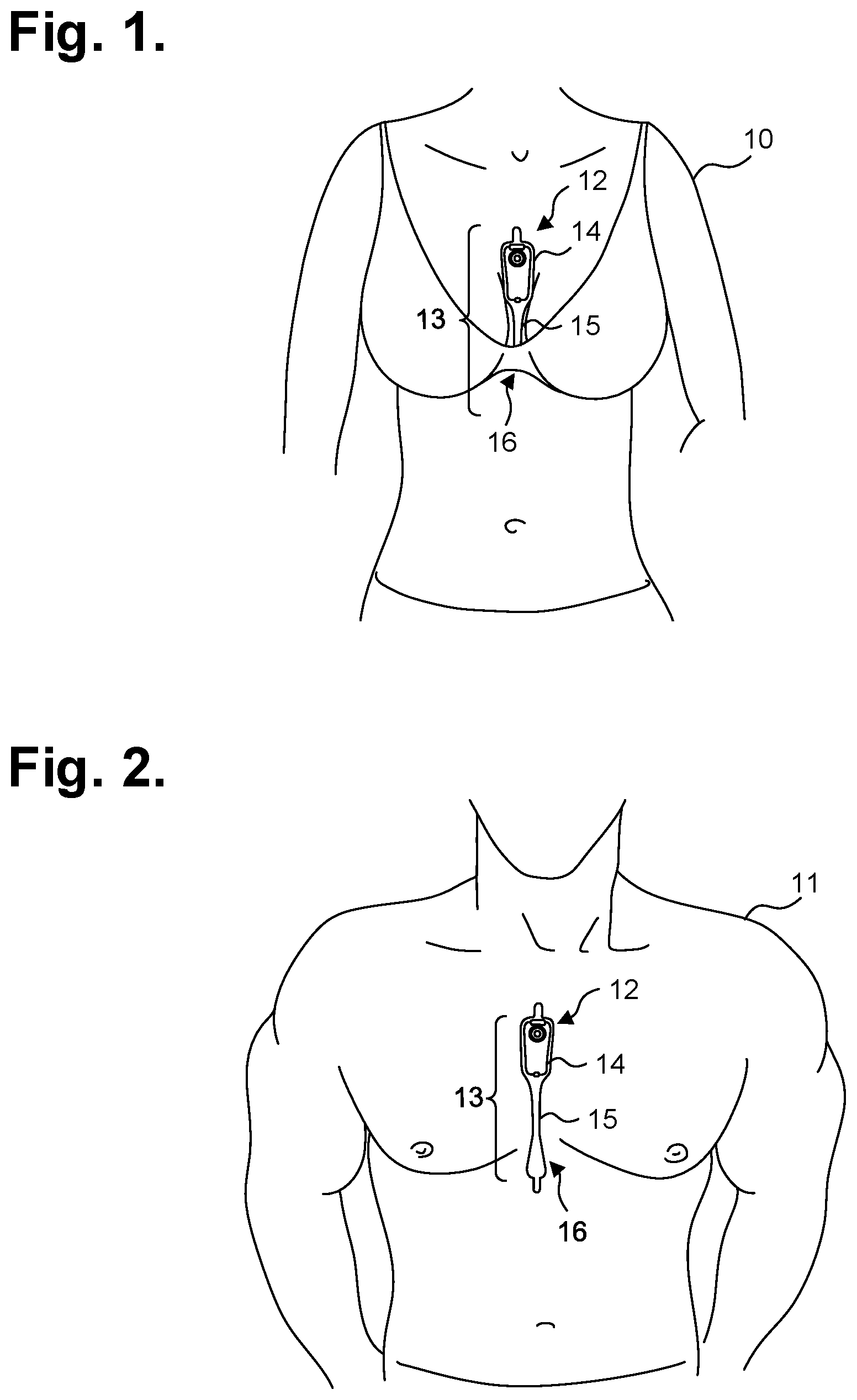 Patent US12324672 — Moisture-resistant electrocardiography monitor — Figure 1