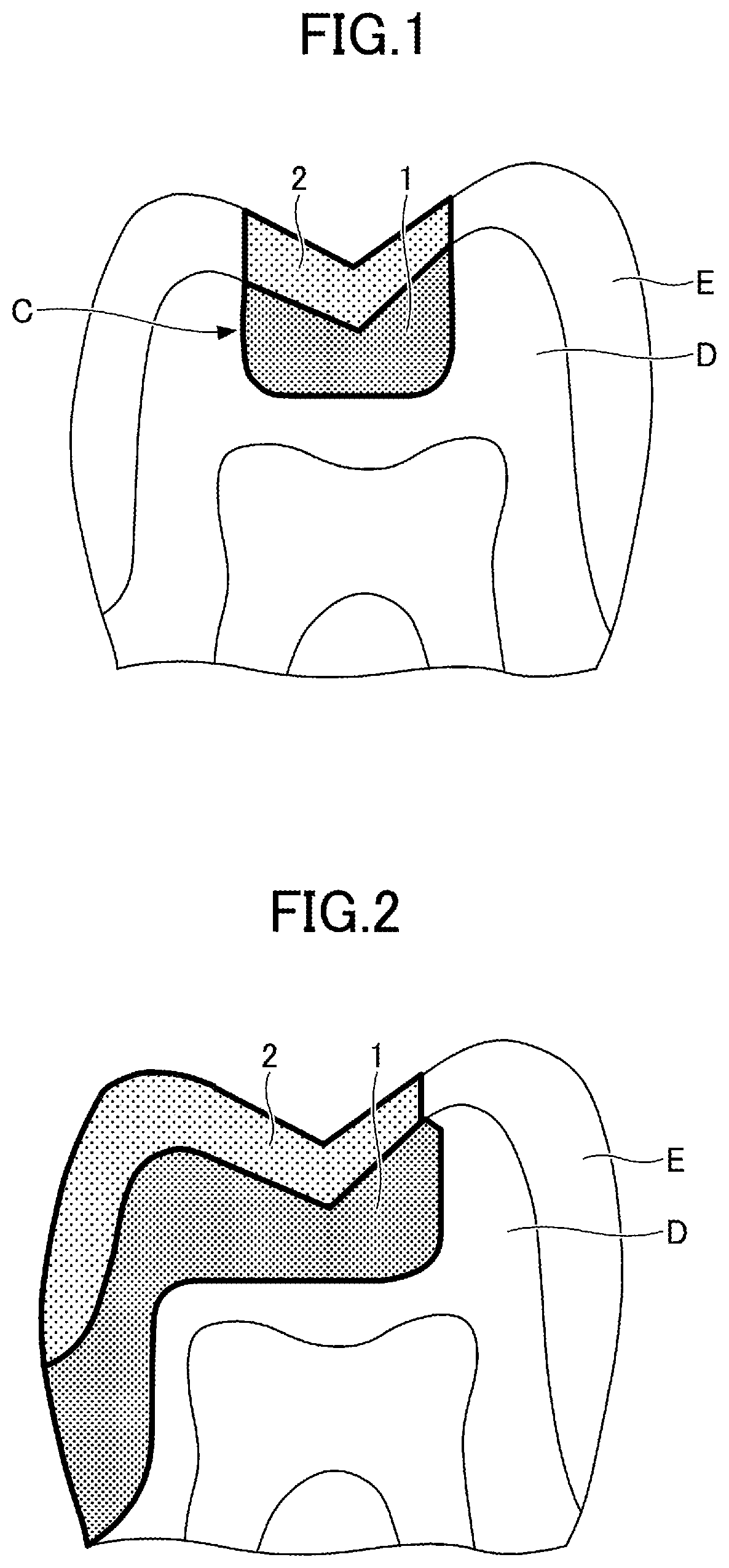 Patent US12324717 — Dental restorative set and method of restoring tooth — Figure 1