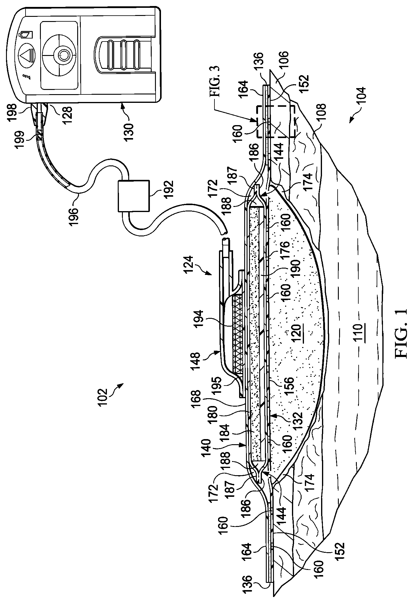 Patent US12324725 — Dressing with sealing and retention interface — Figure 1