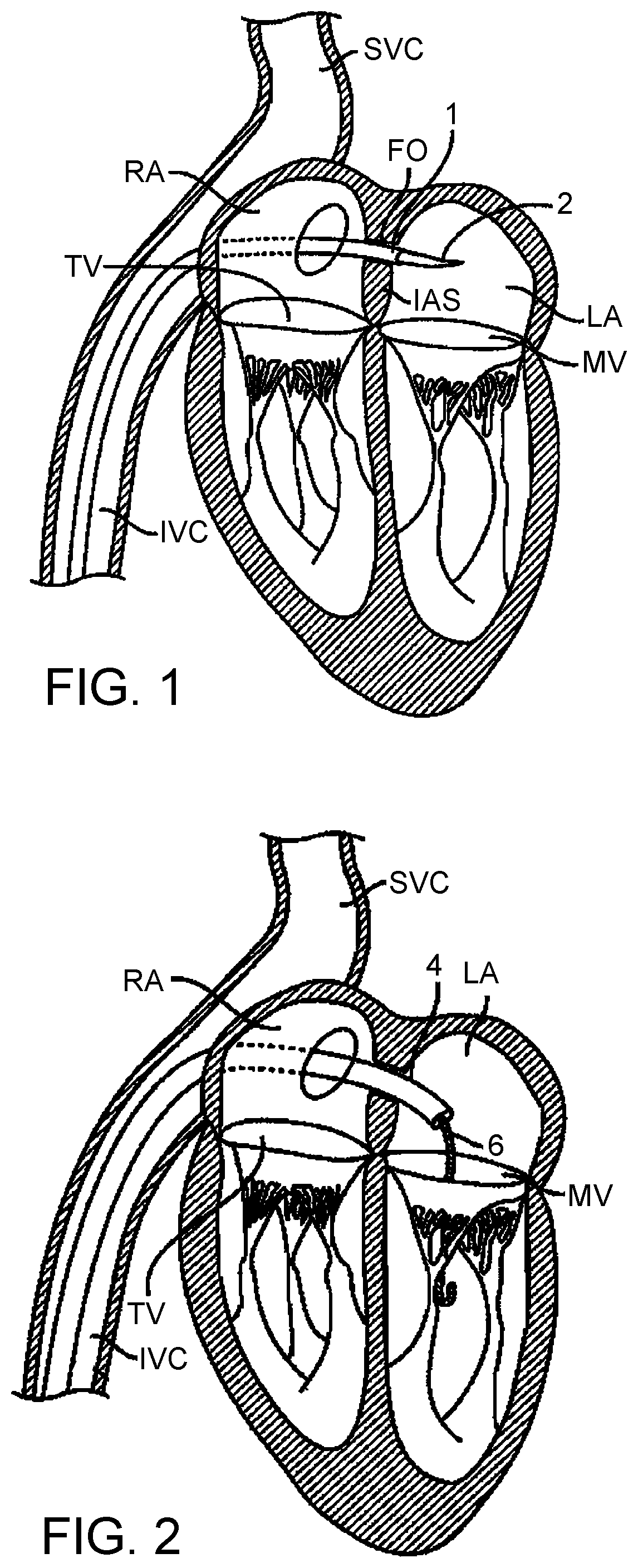Patent US12324738 — Hydraulic delivery systems with flow diversion devices and associated methods — Figure 1