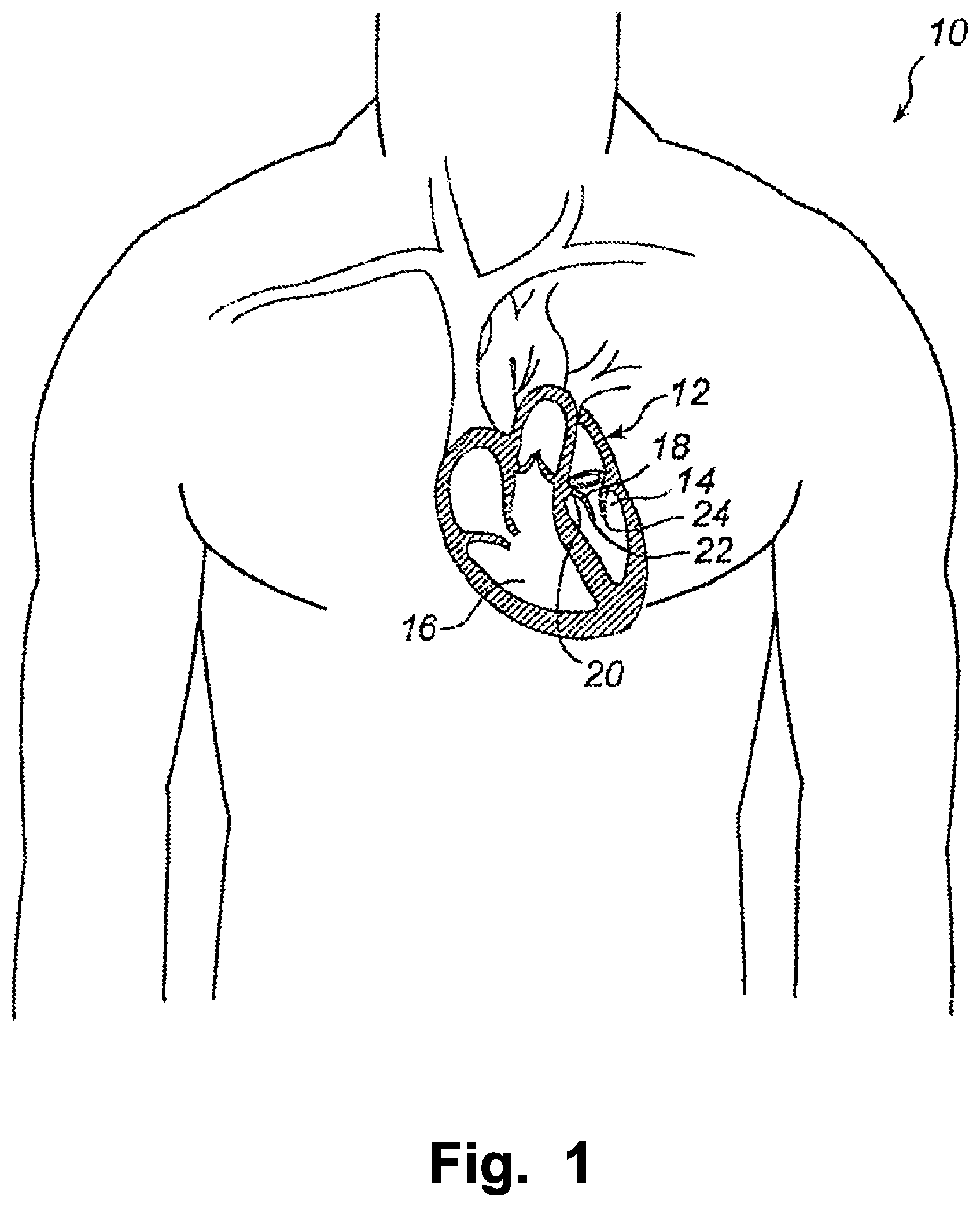 Patent US12324740 — Device and method for improving function of heart valve — Figure 1