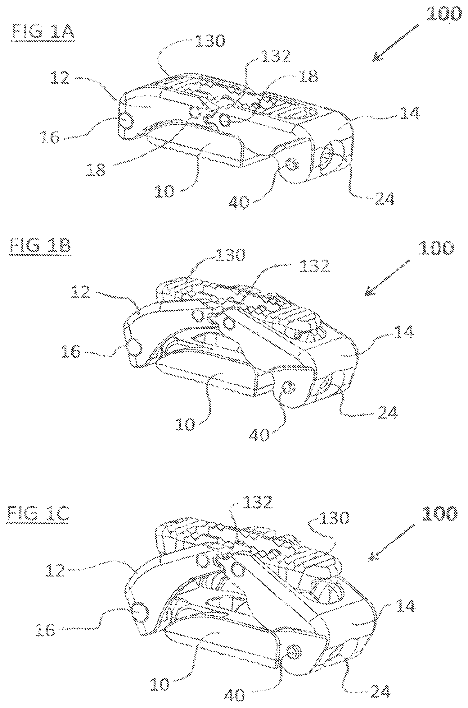 Patent US12324744 — Expandable implant with deflectable sequence of segments — Figure 1