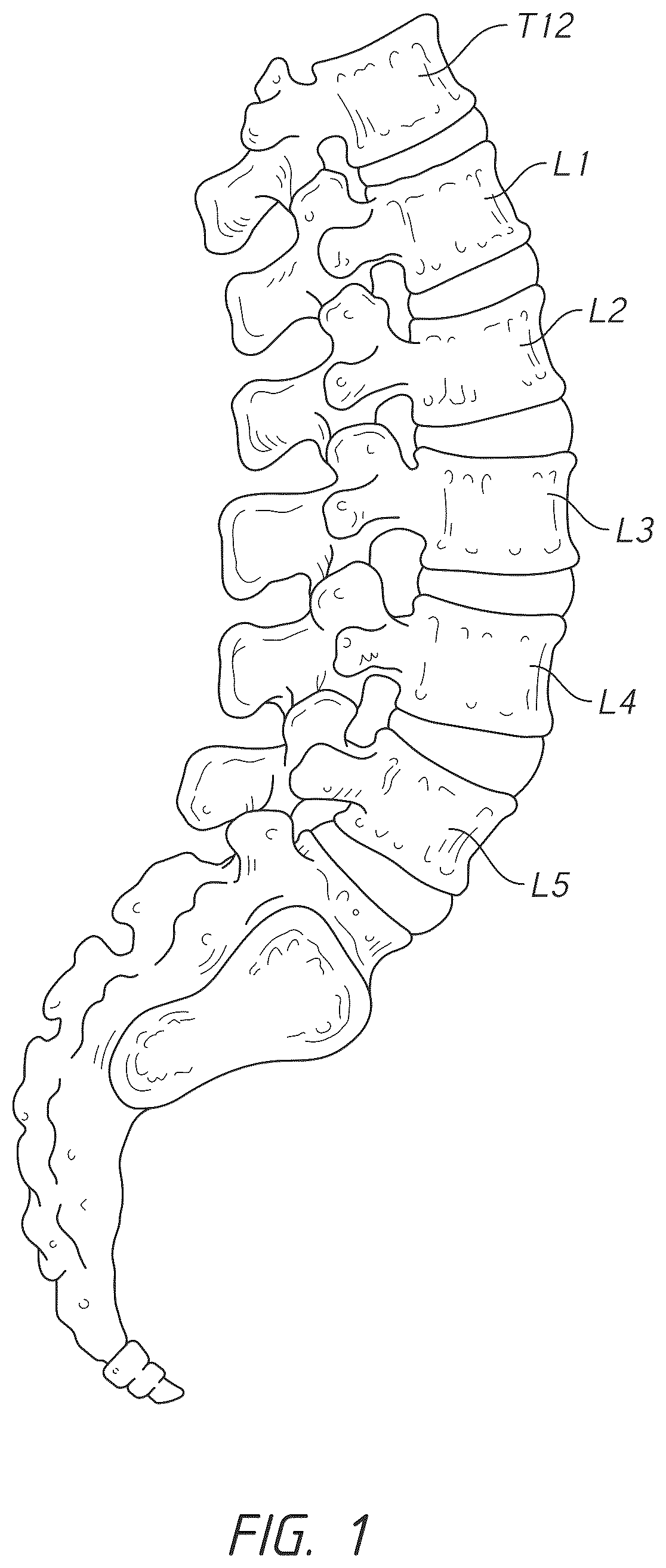 Patent US12324747 — Side pocket spinal fusion cage — Figure 1