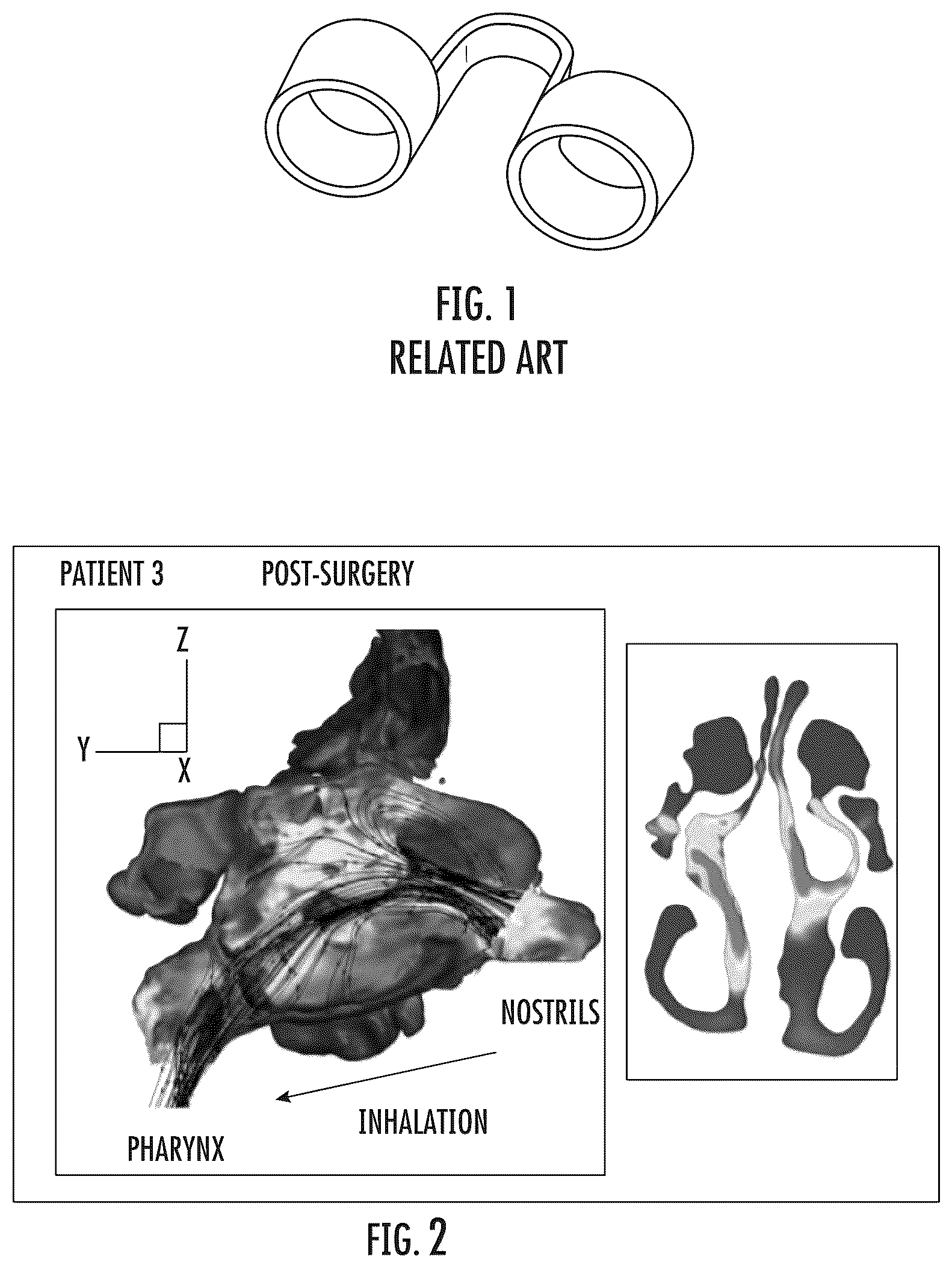 Patent US12324764 Figure 1 – Vented nasal plug