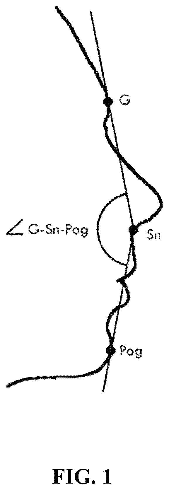 Patent US12324868 — Implants for sculpting, augmenting or correcting facial features such as the chin — Figure 1