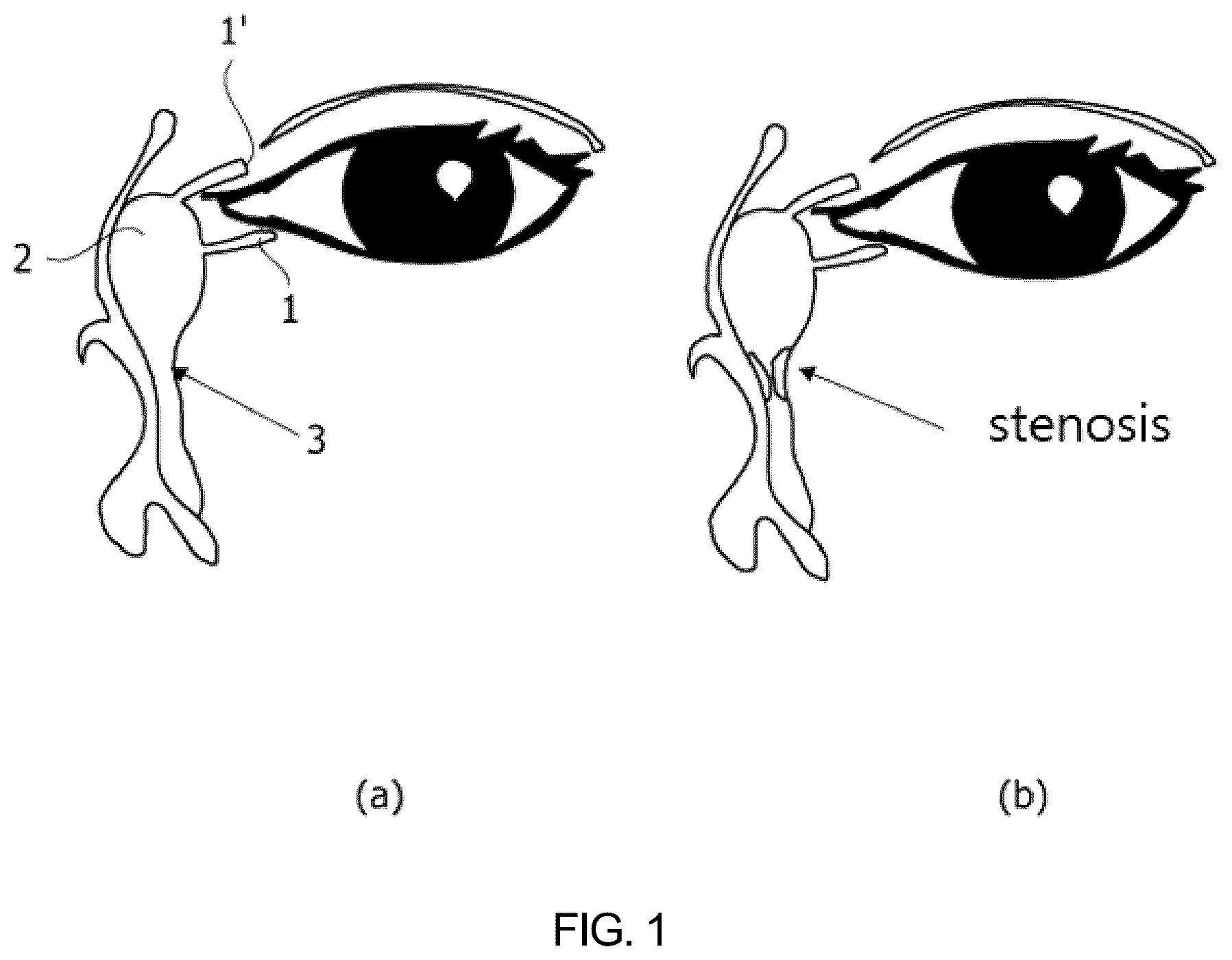 Patent US12324870 Figure 1 – Nasolacrimal duct insertion member comprising shape memory polymer