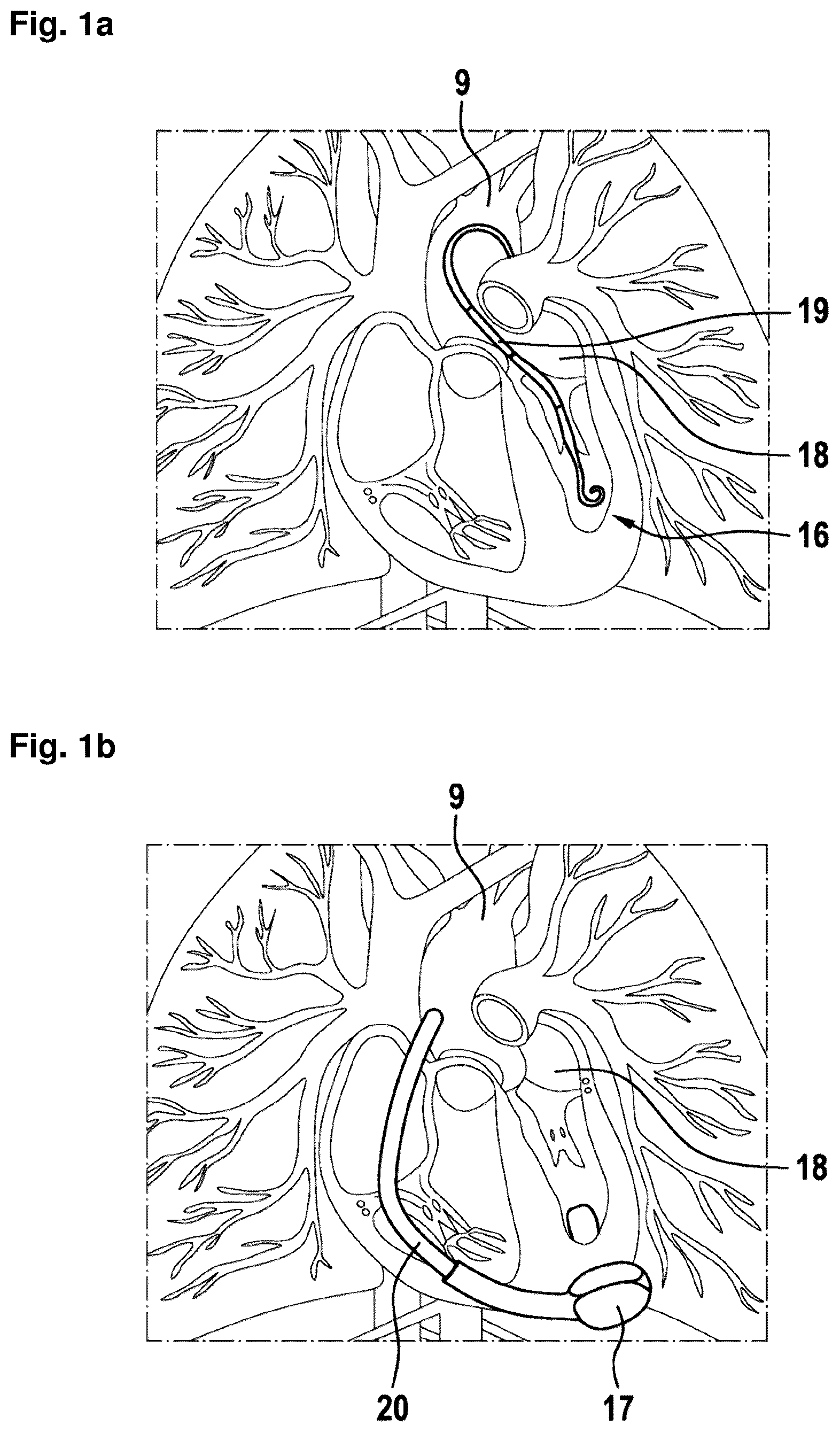 Patent US12324906 — Systems and methods for determining a total blood volume flow in a cardiac support system and vascular support system — Figure 1