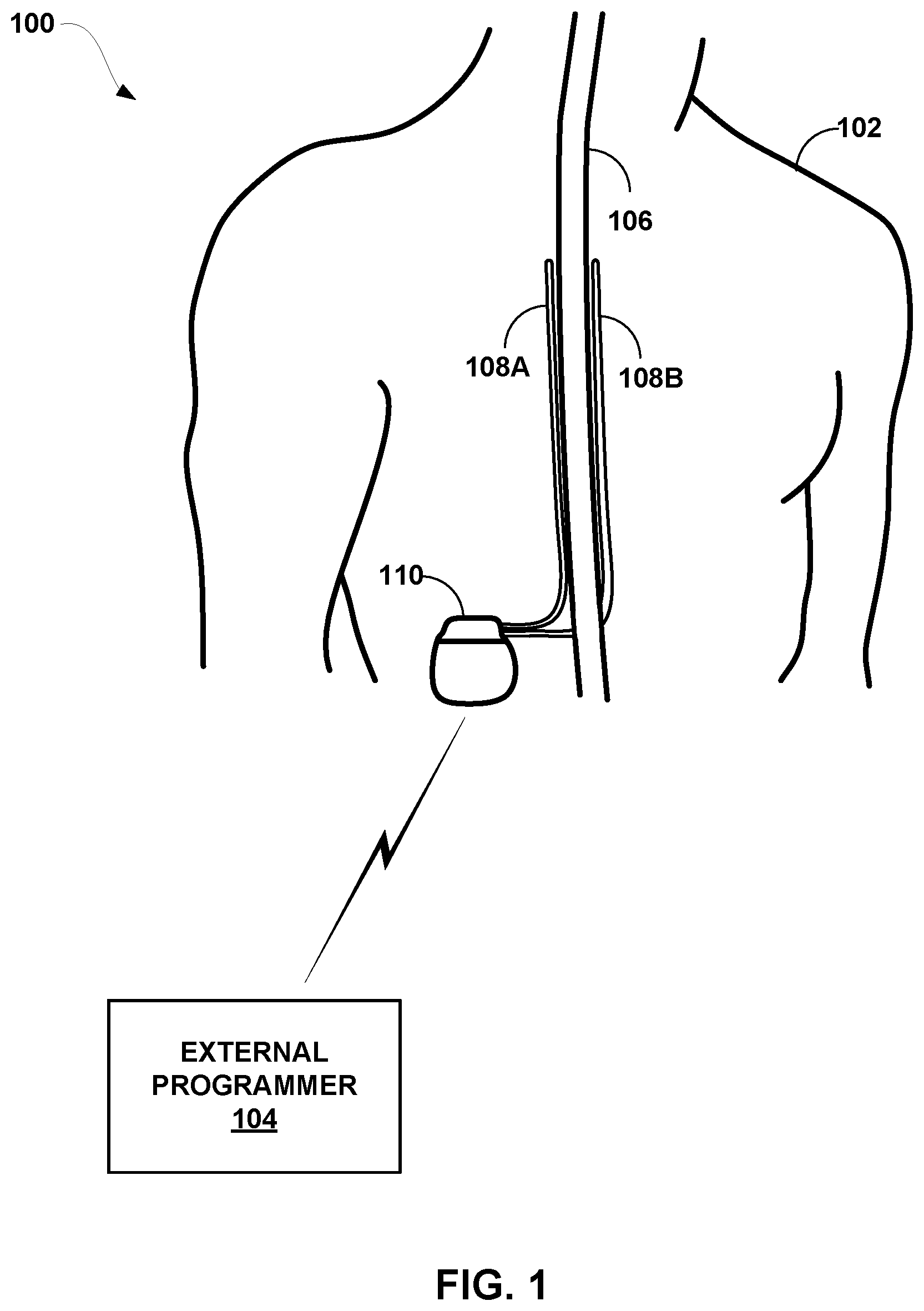 Patent US12324916 Figure 1 – Hybrid control policy for ECAP-servoed neuromodulation