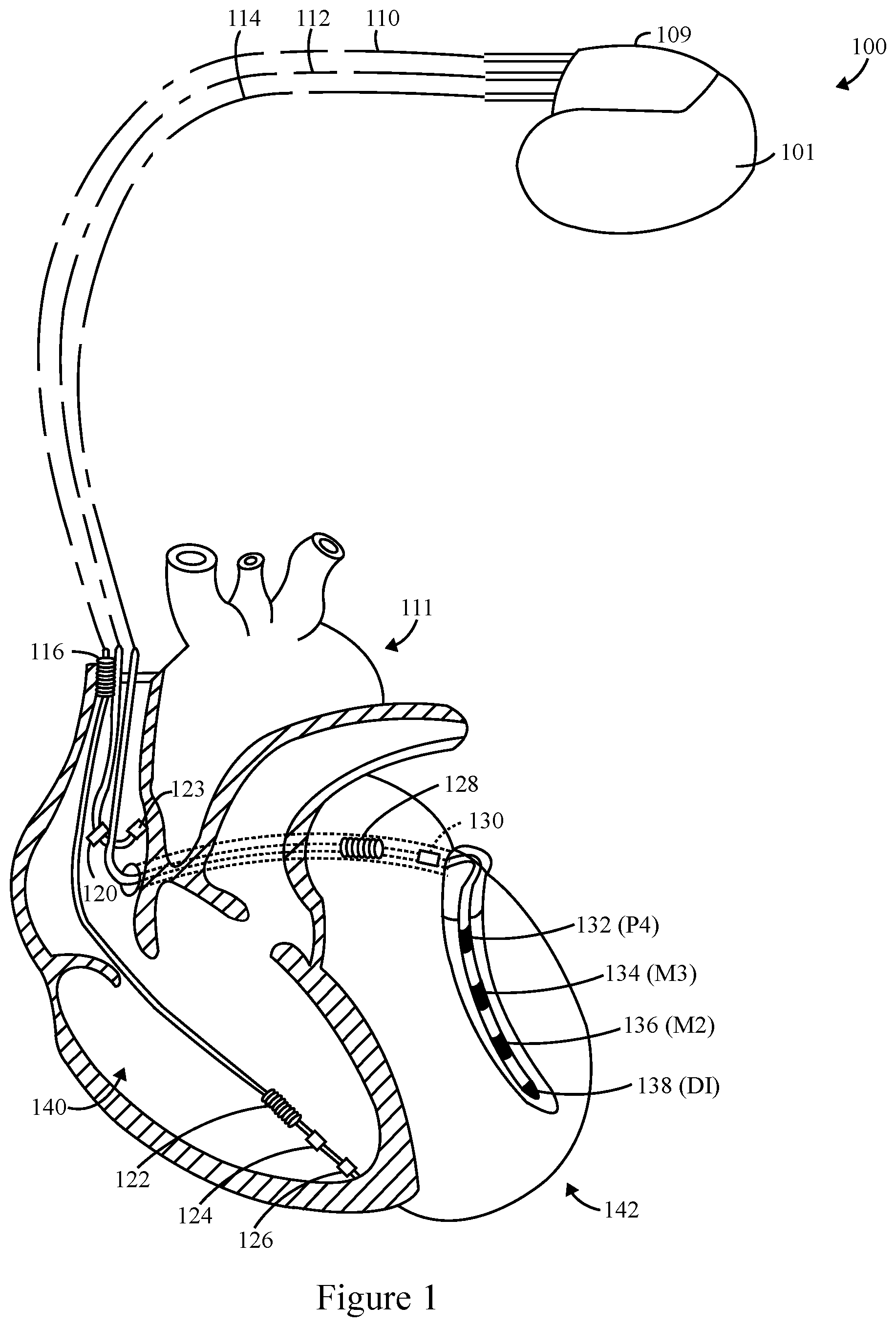 Patent US12324919 Figure 1 – Method and system for biventricular or left ventricular pacing