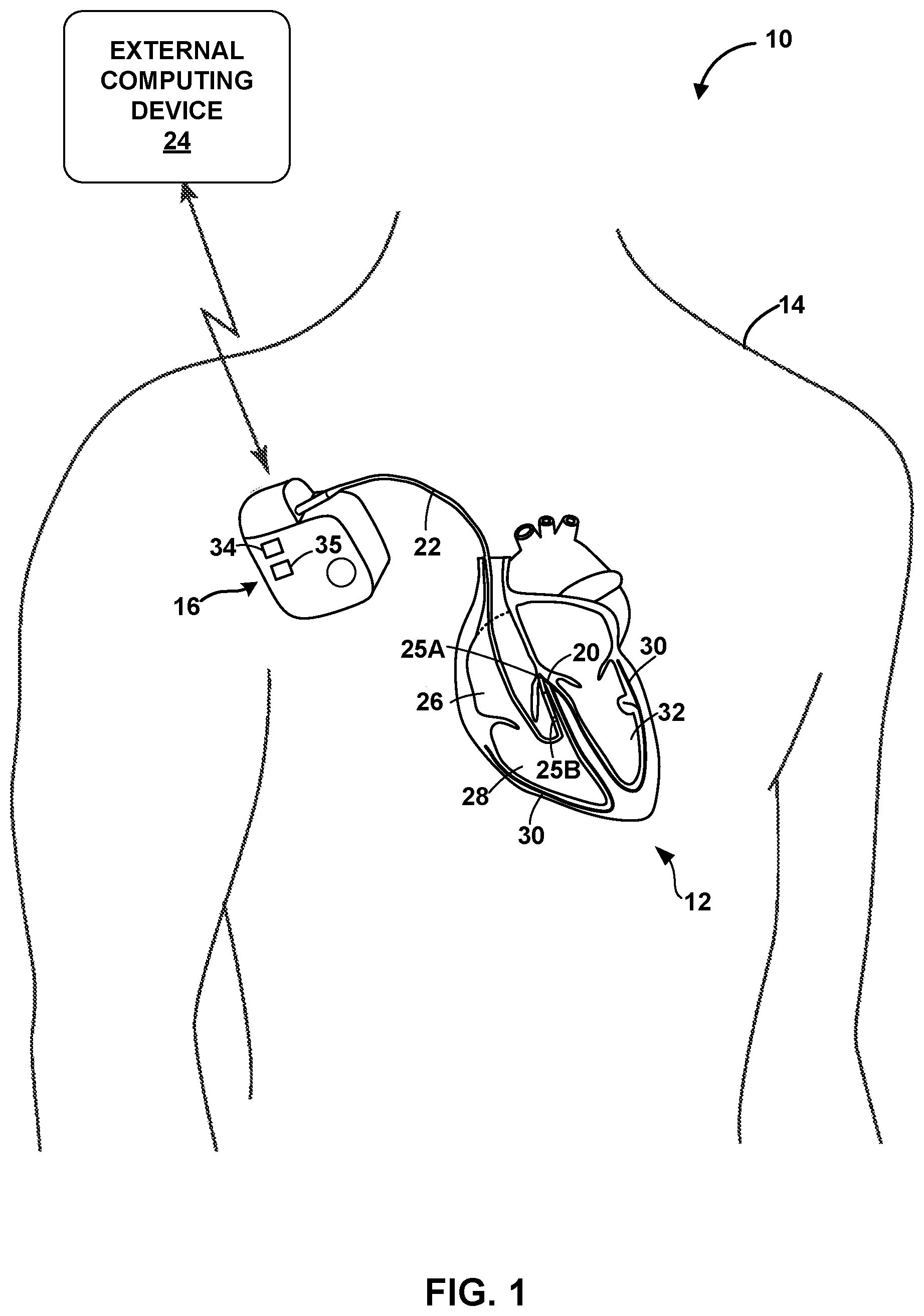 Patent US12324920 — Implantable medical device with pacing capture classification — Figure 1
