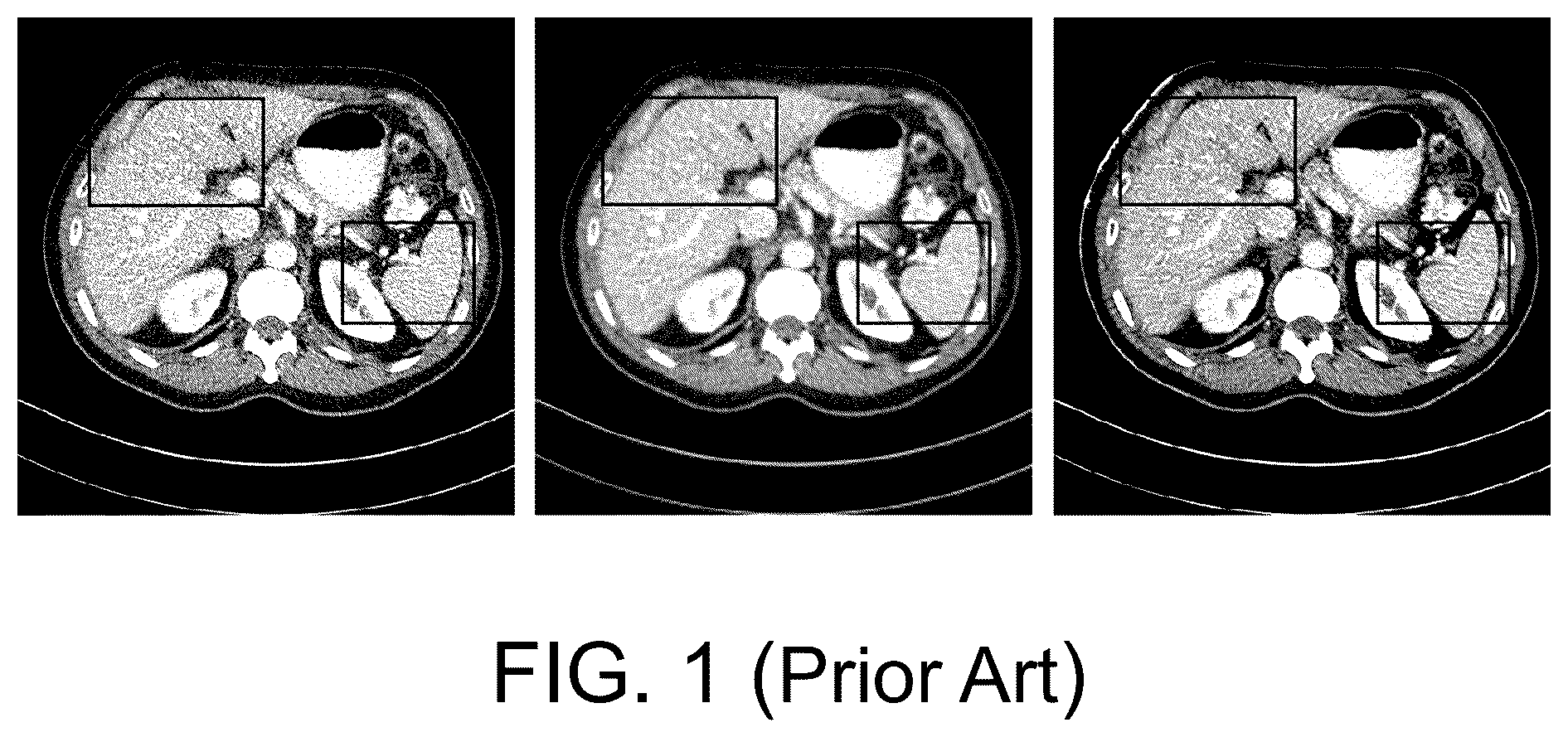 Patent US12333686 Figure 1 – Zero-shot low-dose CT image denoising method and apparatus based on strip diffusion model