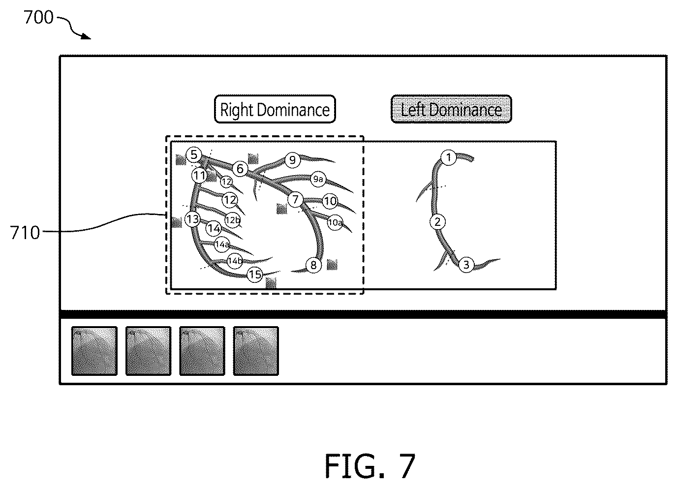 Patent US12333723 Figure 7 – Method and system for computing syntax score using cardio angiogram