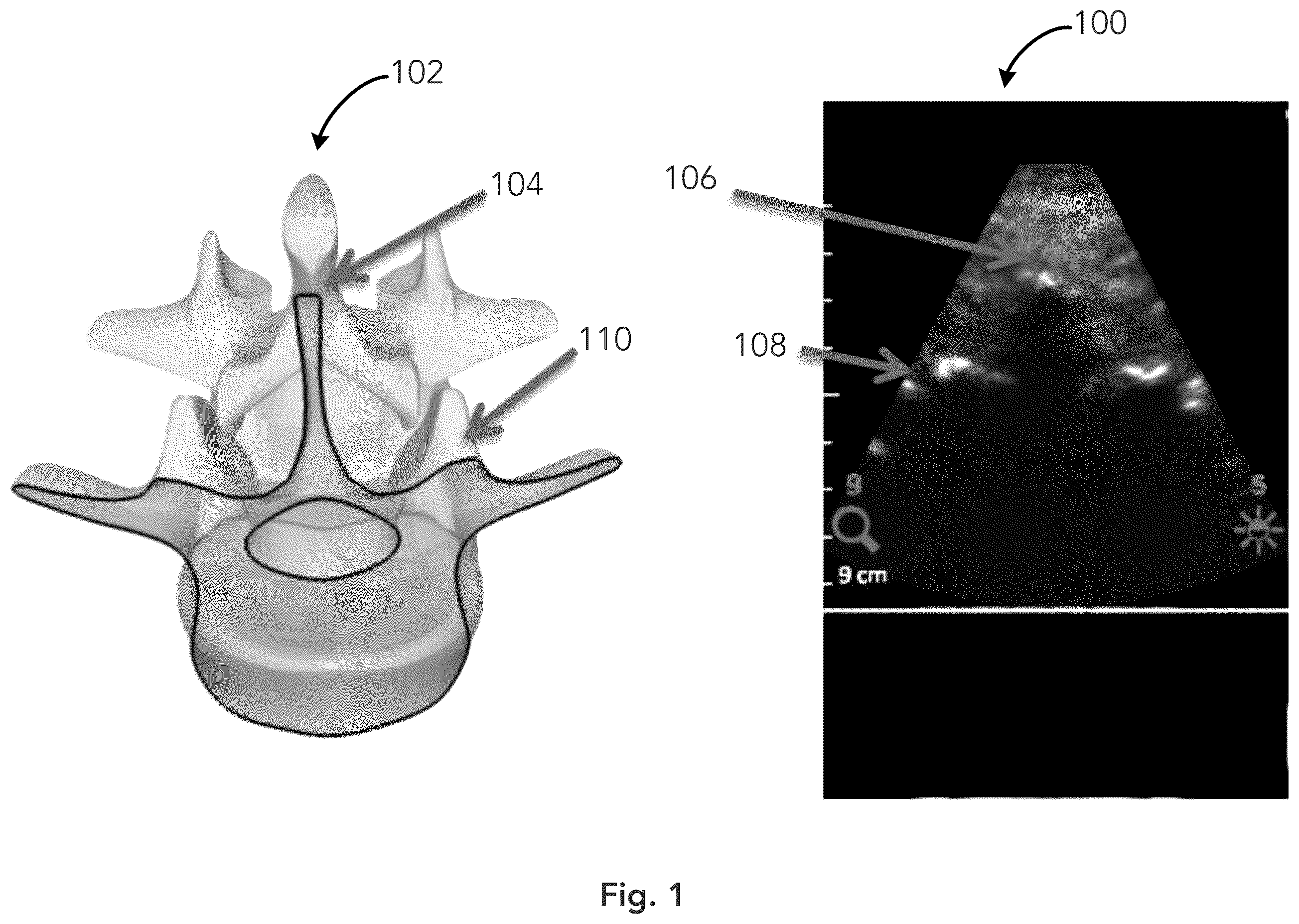 Patent US12333783 — System and method for ultrasound spine shadow feature detection and imaging thereof — Figure 1