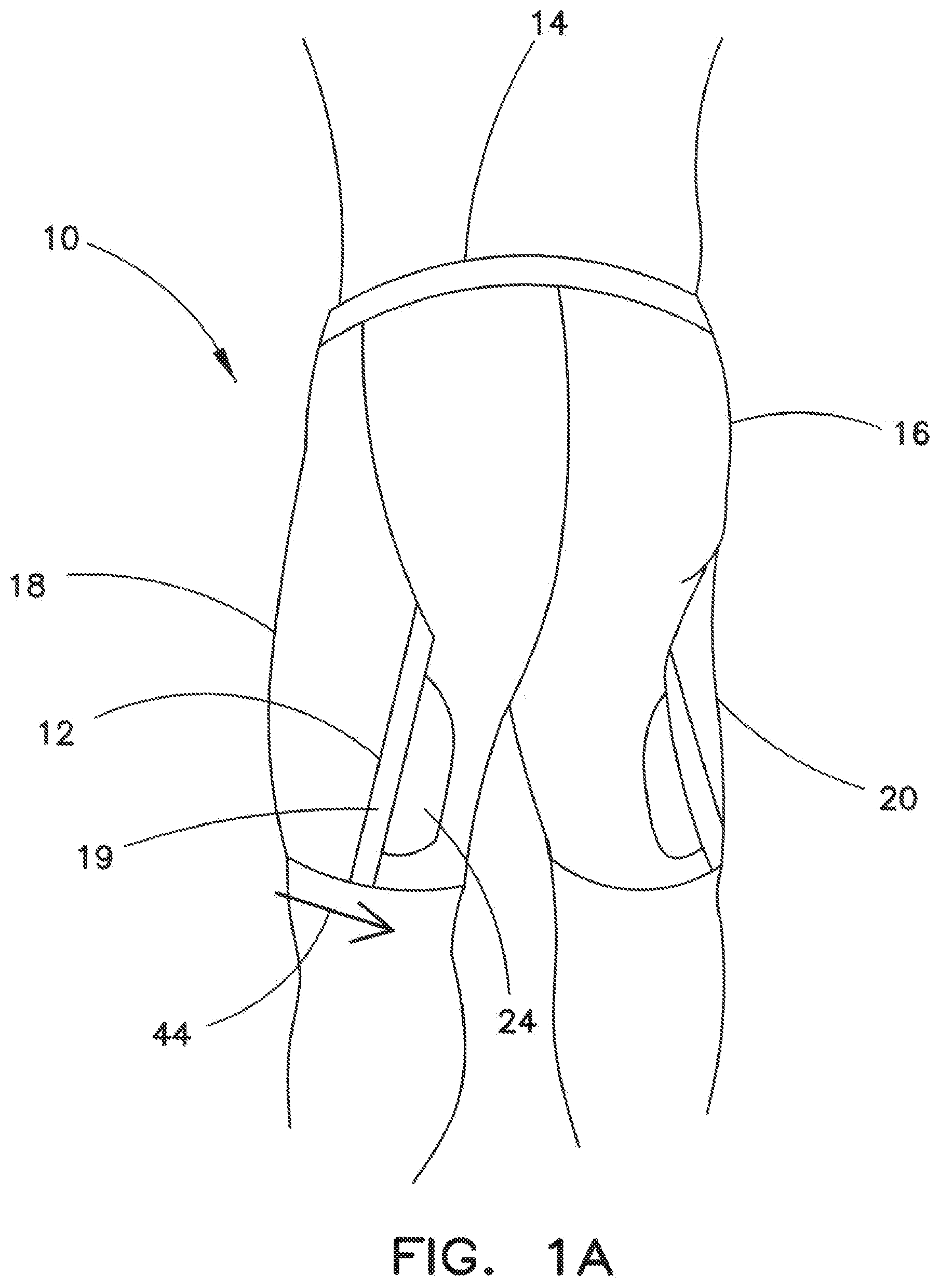 Patent US12342888 Figure 1 – Garment with compression adjustment arrangement