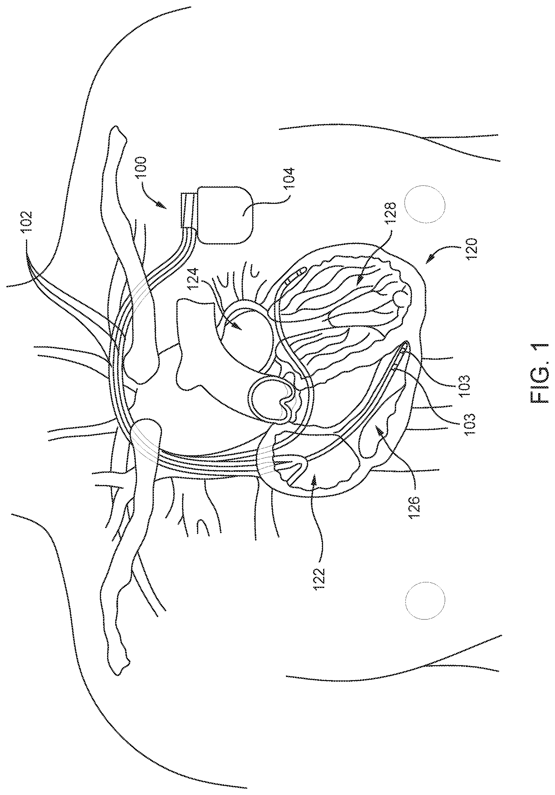 Patent US12350021 — Non-barometric determination of hemodynamic effects of cardiac arrhythmias using signals sensed by an implantable device — Figure 1