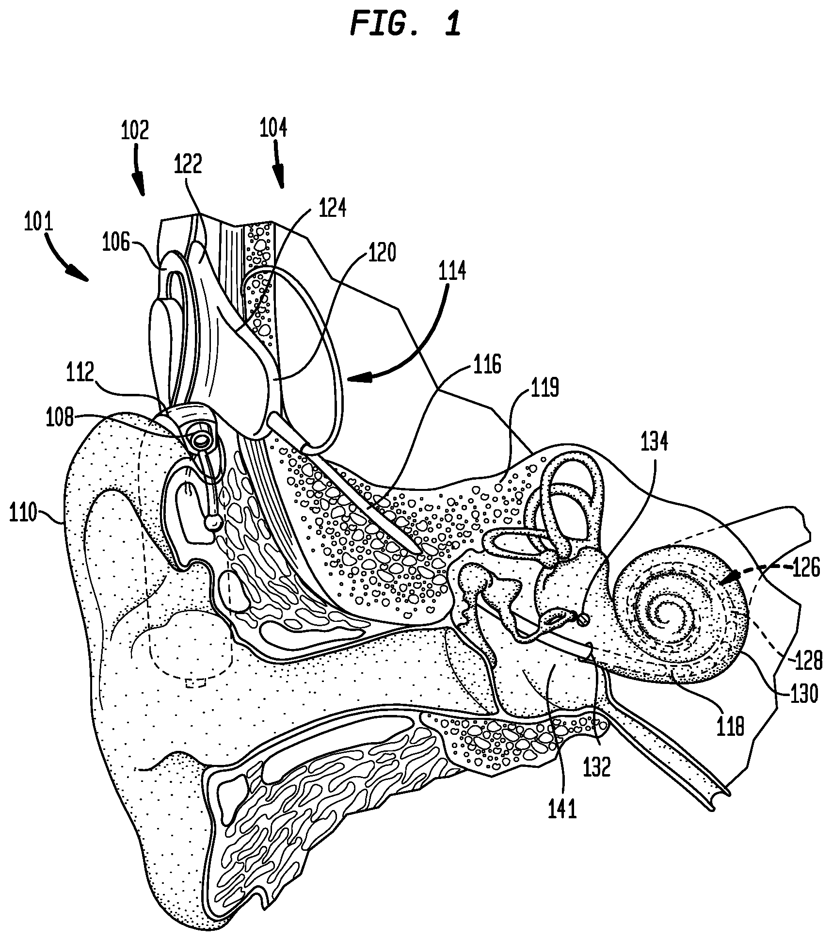 Patent US12350030 — Event detection in an implantable auditory prosthesis — Figure 1