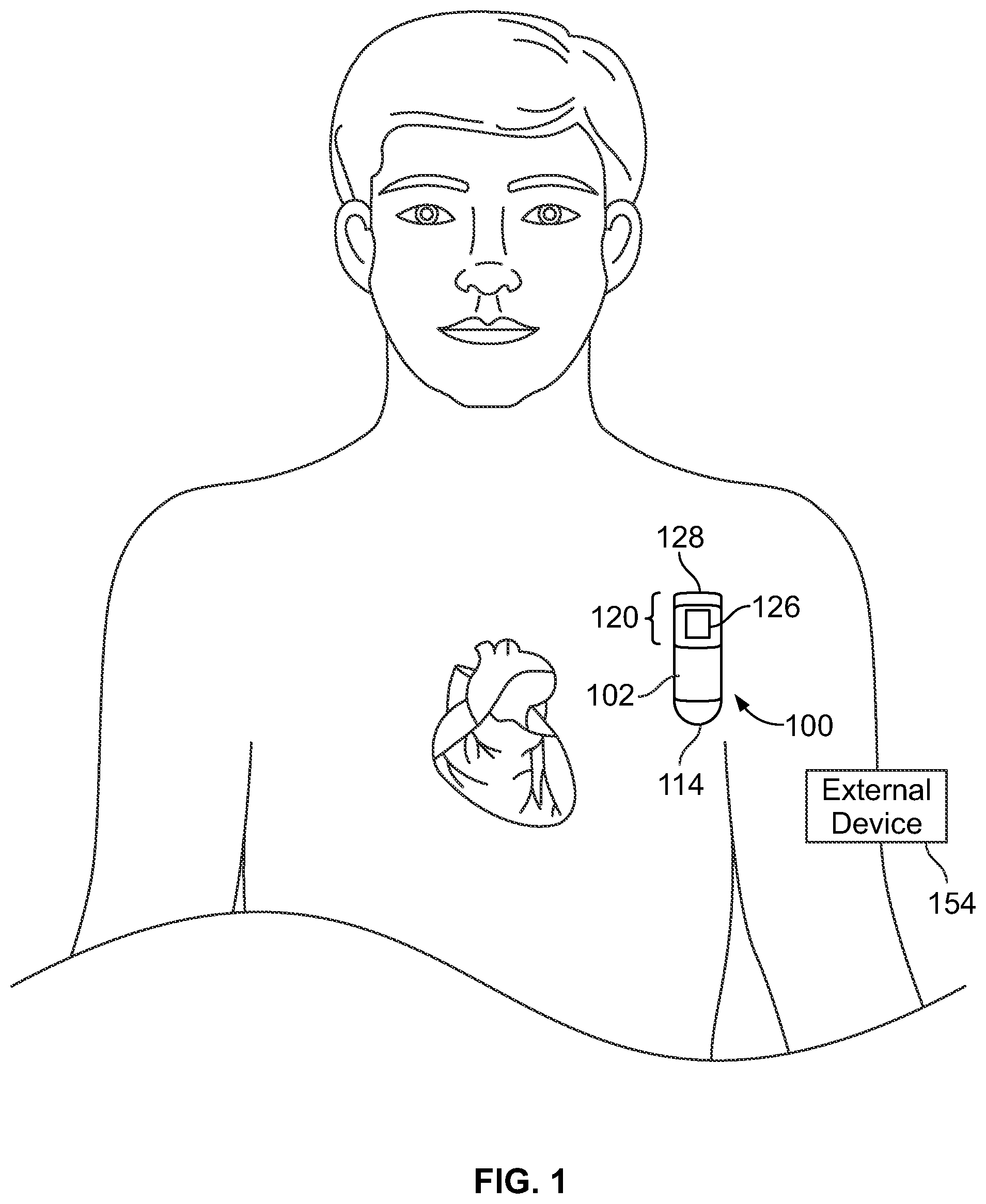 Patent US12350058 — System for identifying premature ventricular contractions — Figure 1