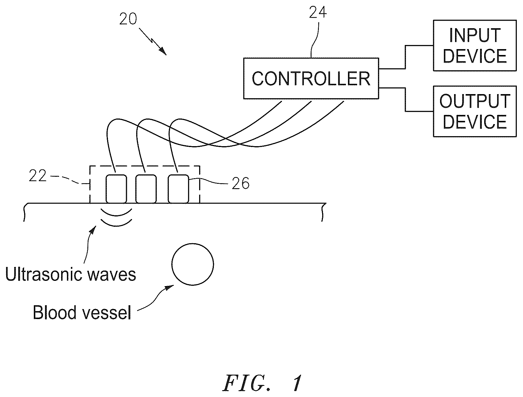 Patent US12350093 Figure 1 – Apparatus and method for tracking blood vessel cross-section