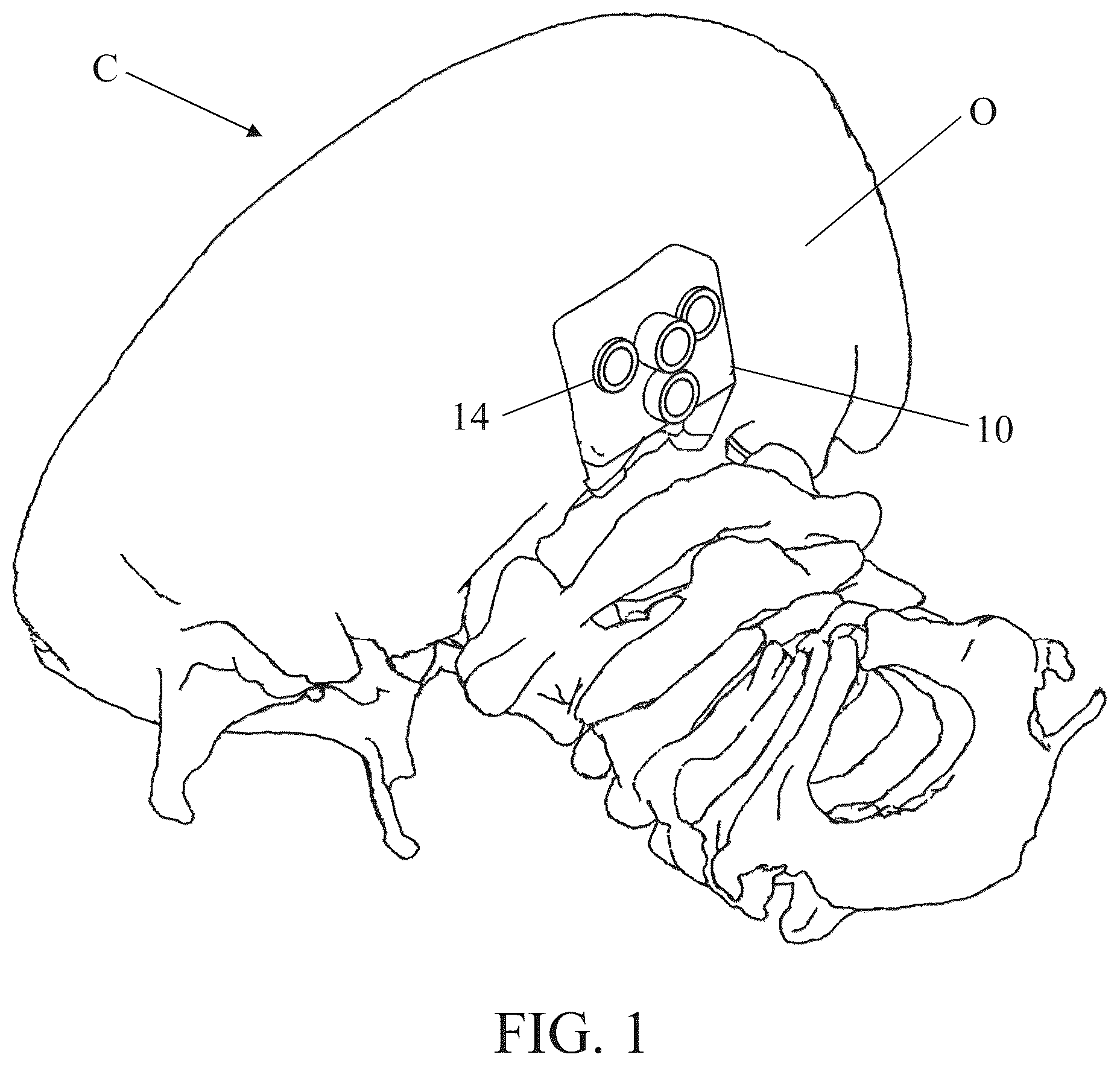 Patent US12350111 — Patient-matched apparatus for use in robotic assisted surgical procedures and methods for using the same — Figure 1