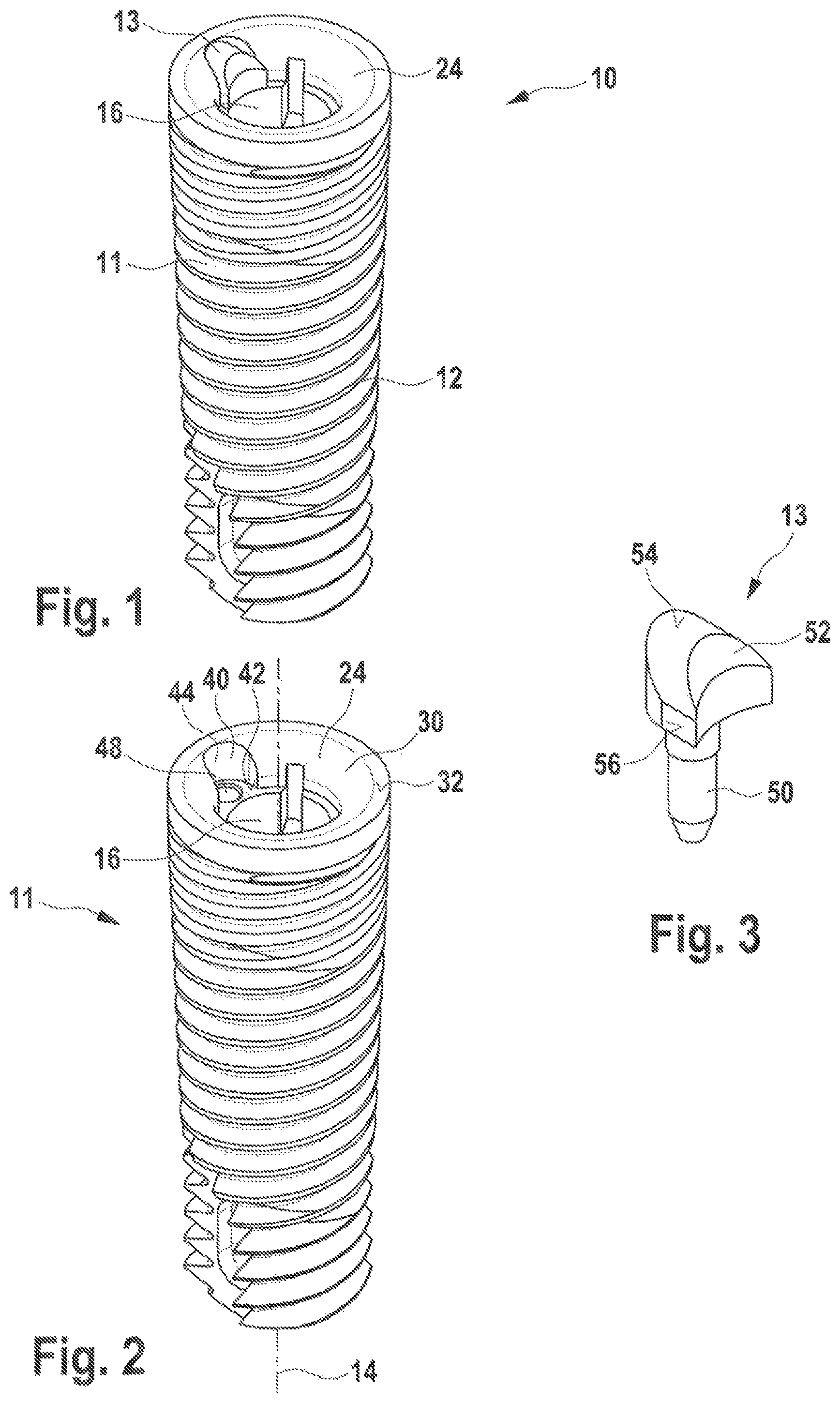 Patent US12350125 Figure 1 – Dental implant and dental prosthesis