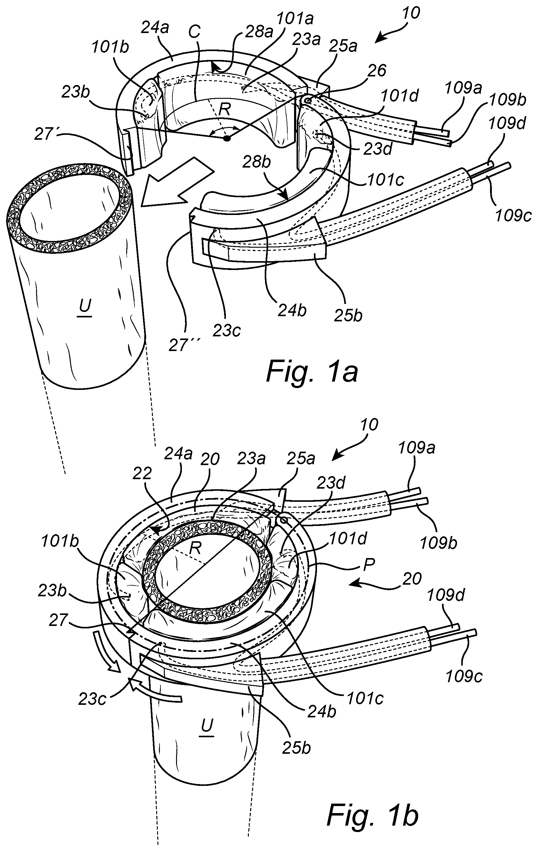 Patent US12350138 — Implantable urethra restriction device — Figure 1