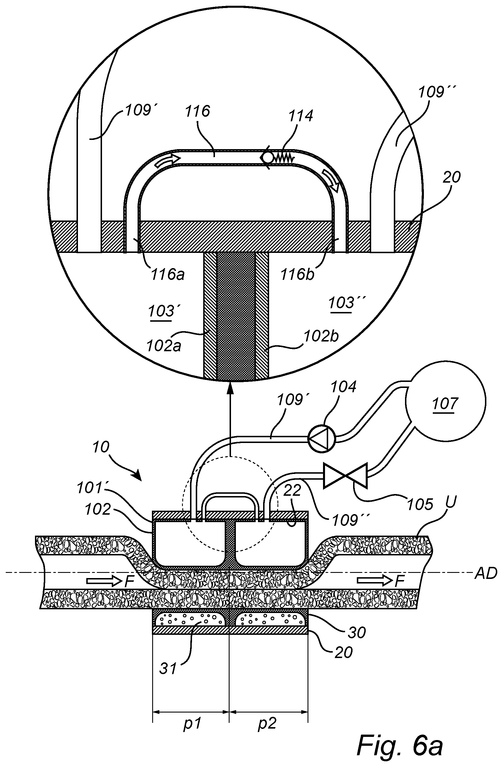 Patent US12350138 Figure 10 – Implantable urethra restriction device