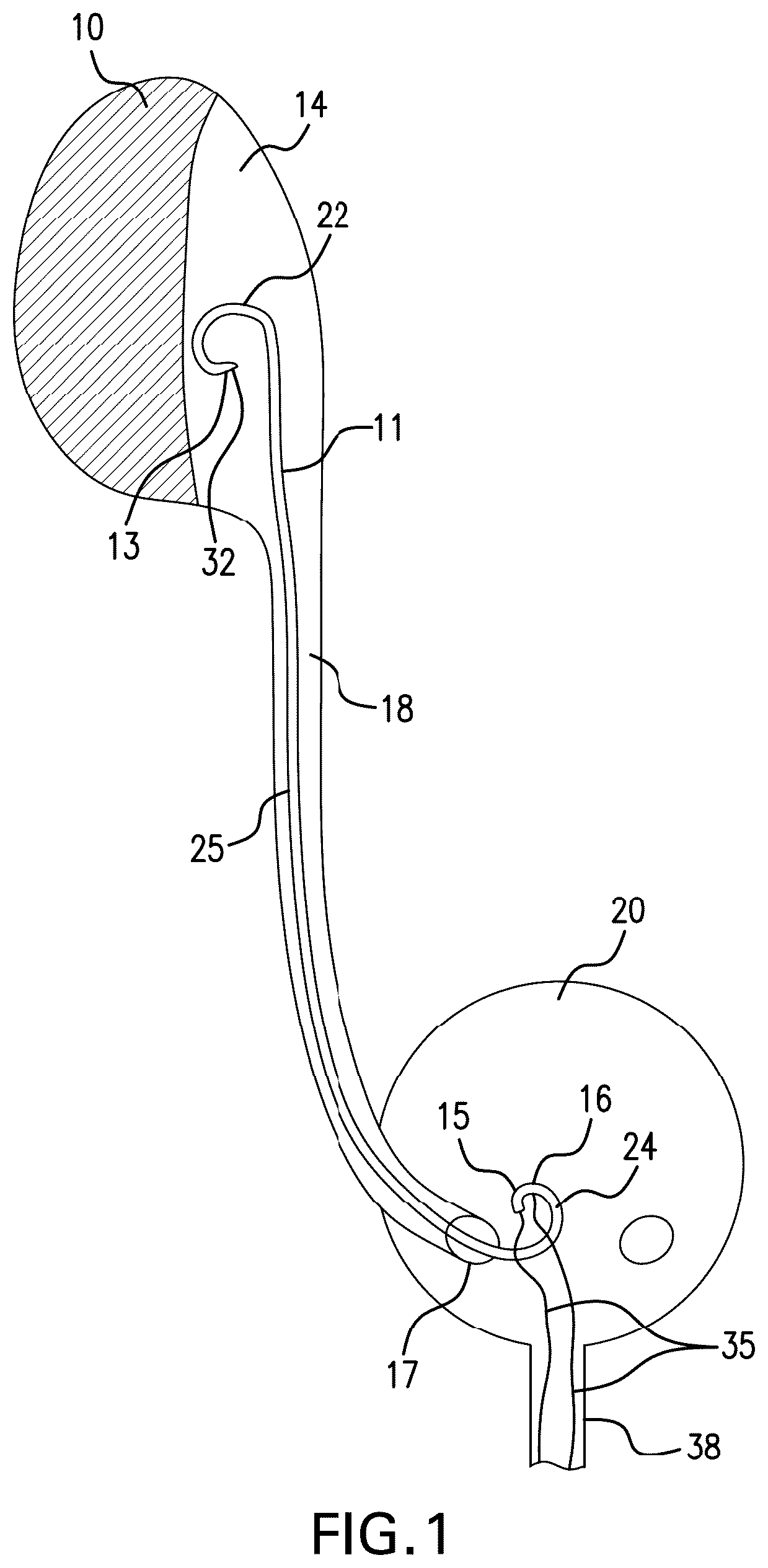 Patent US12350140 Figure 1 – Variable length stent