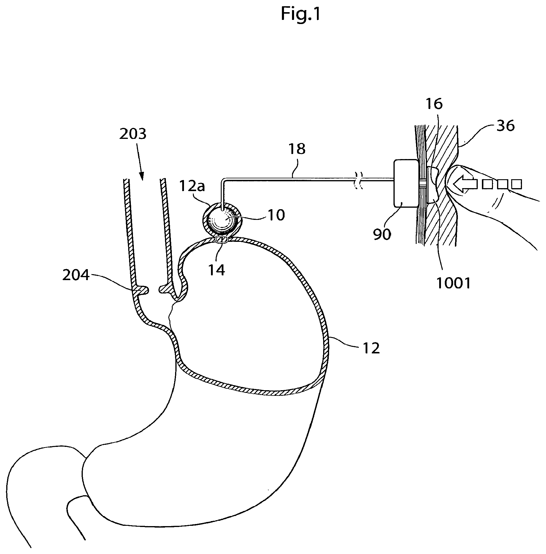 Patent US12350141 — Method and instrument for treating obesity — Figure 1