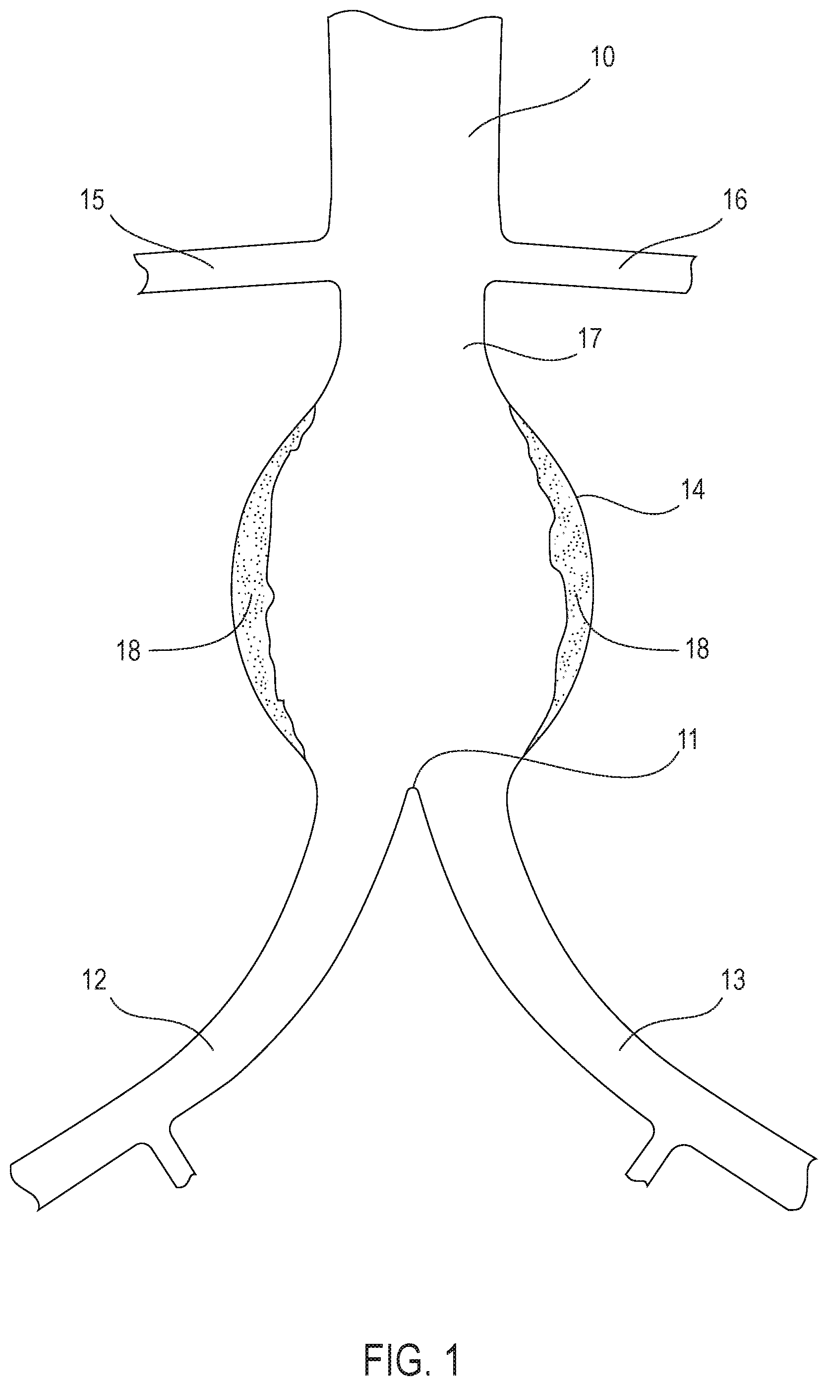 Patent US12350142 — Systems and methods with graft body, inflatable fill channel, and filling structure — Figure 1
