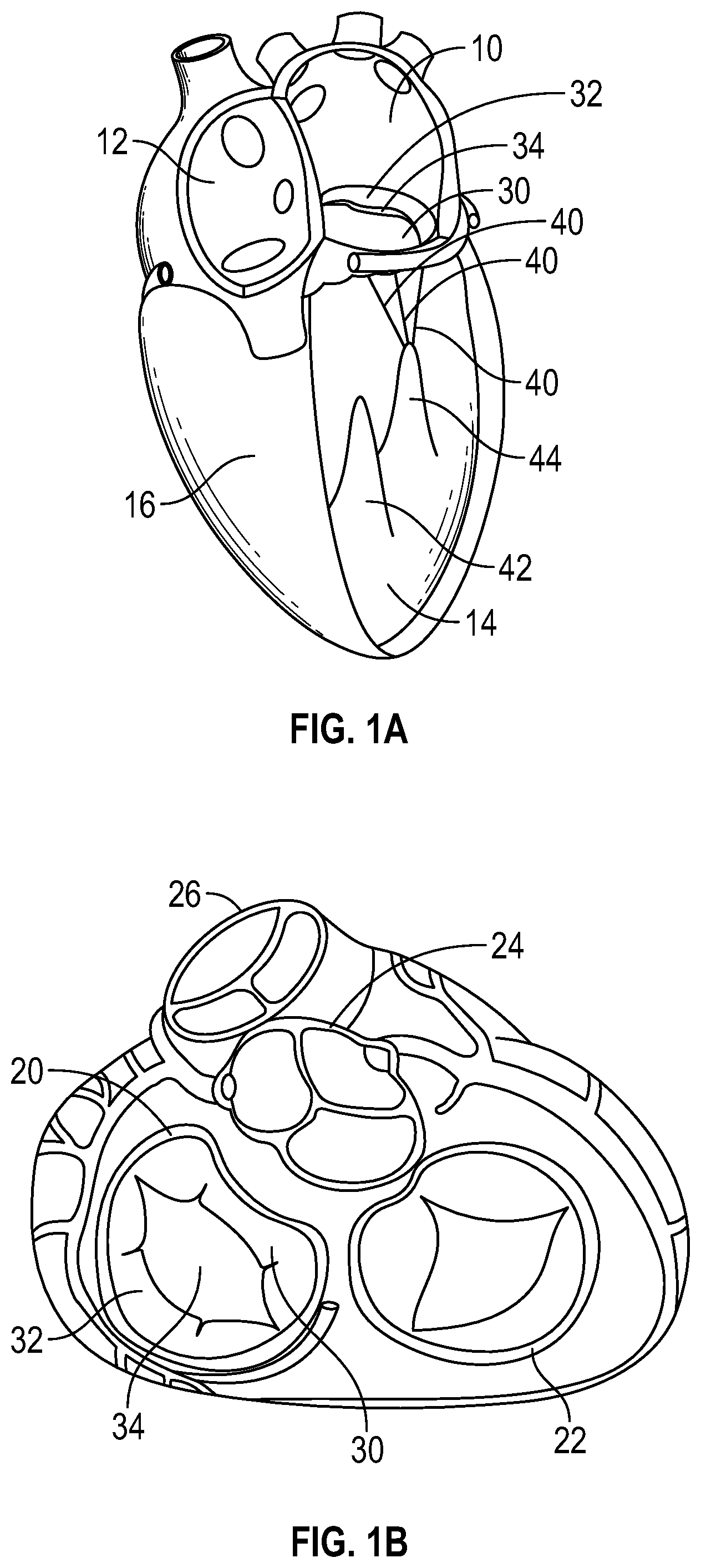 Patent US12350153 — Systems and methods for transcatheter treatment of valve regurgitation — Figure 1