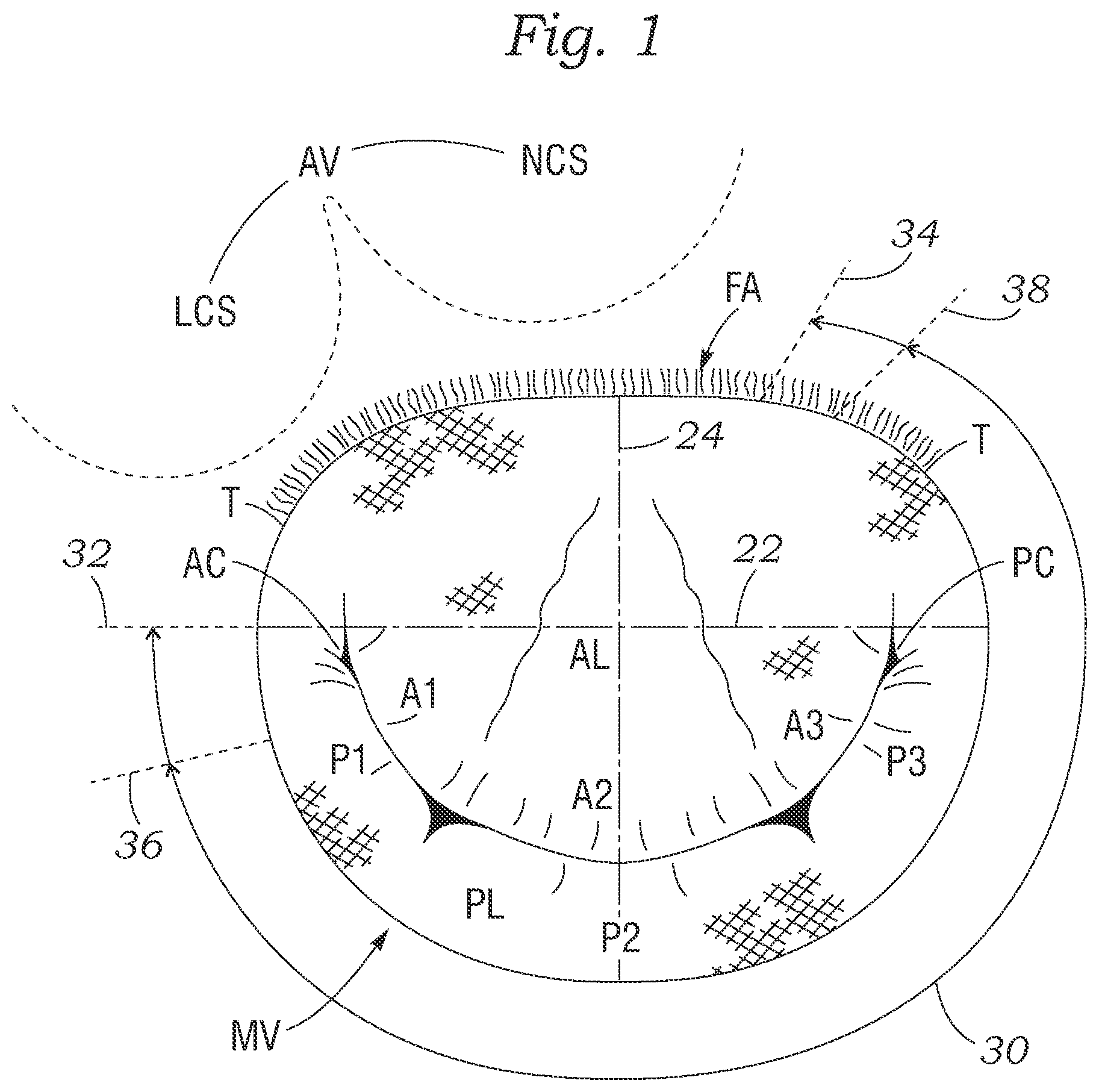 Patent US12350154 — Method for implanting an asymmetric mitral annuloplasty band — Figure 1