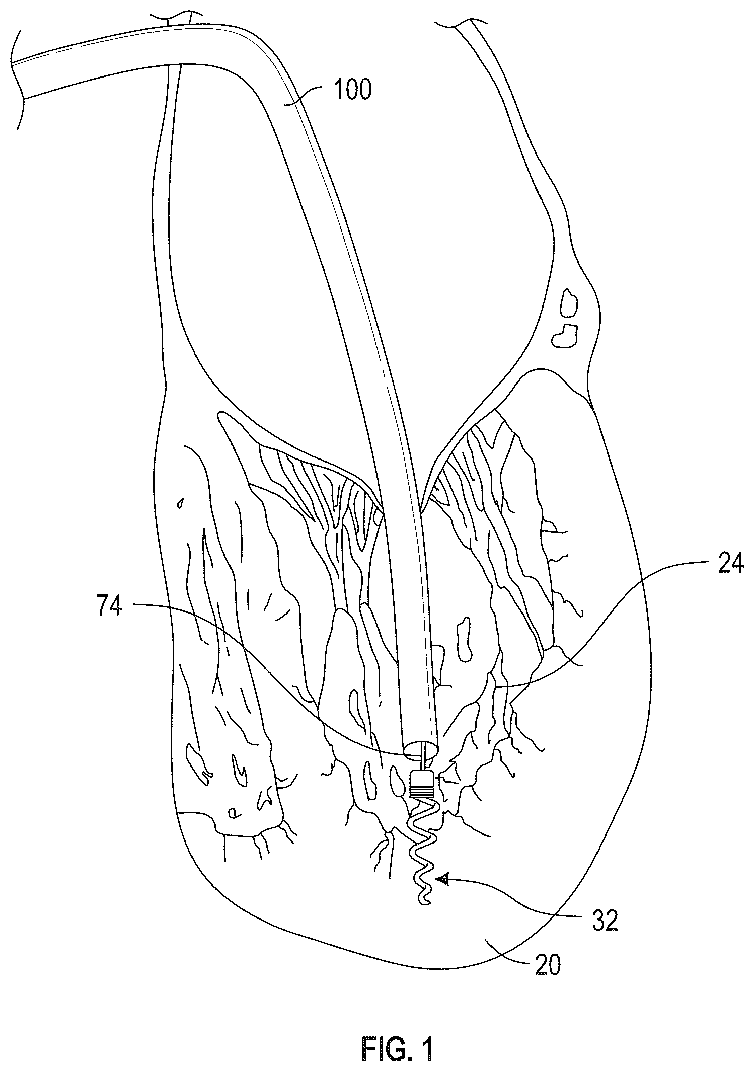Patent US12350155 — Method and apparatus for mitral valve chord repair — Figure 1