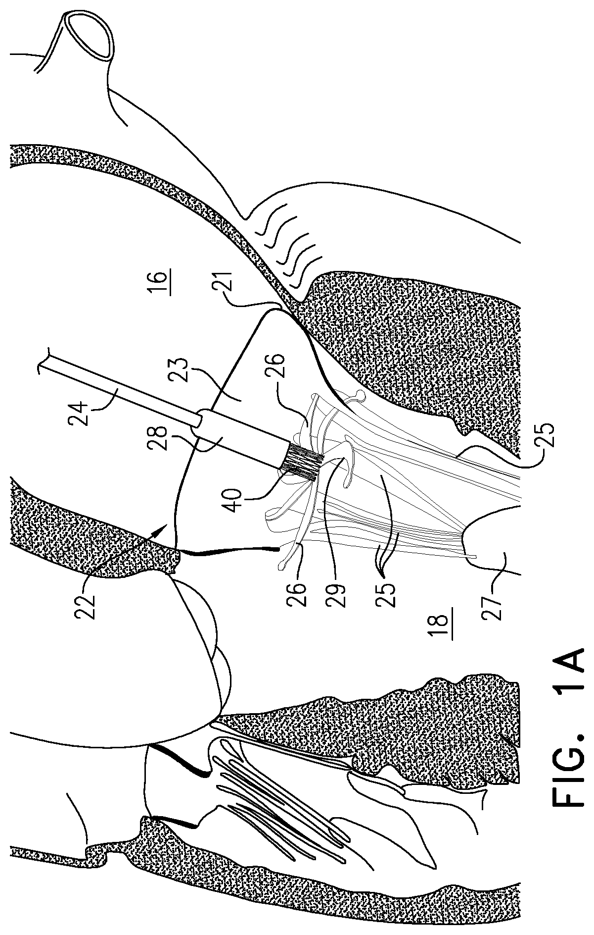 Patent US12350156 — Atrioventricular valve repair — Figure 1