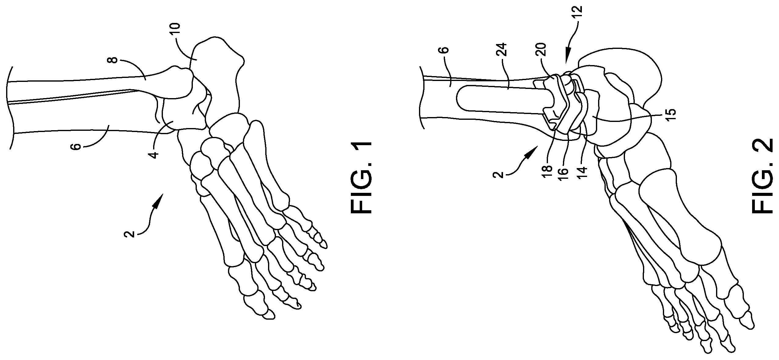 Patent US12350163 Figure 1 – Modular talar fixation method and system