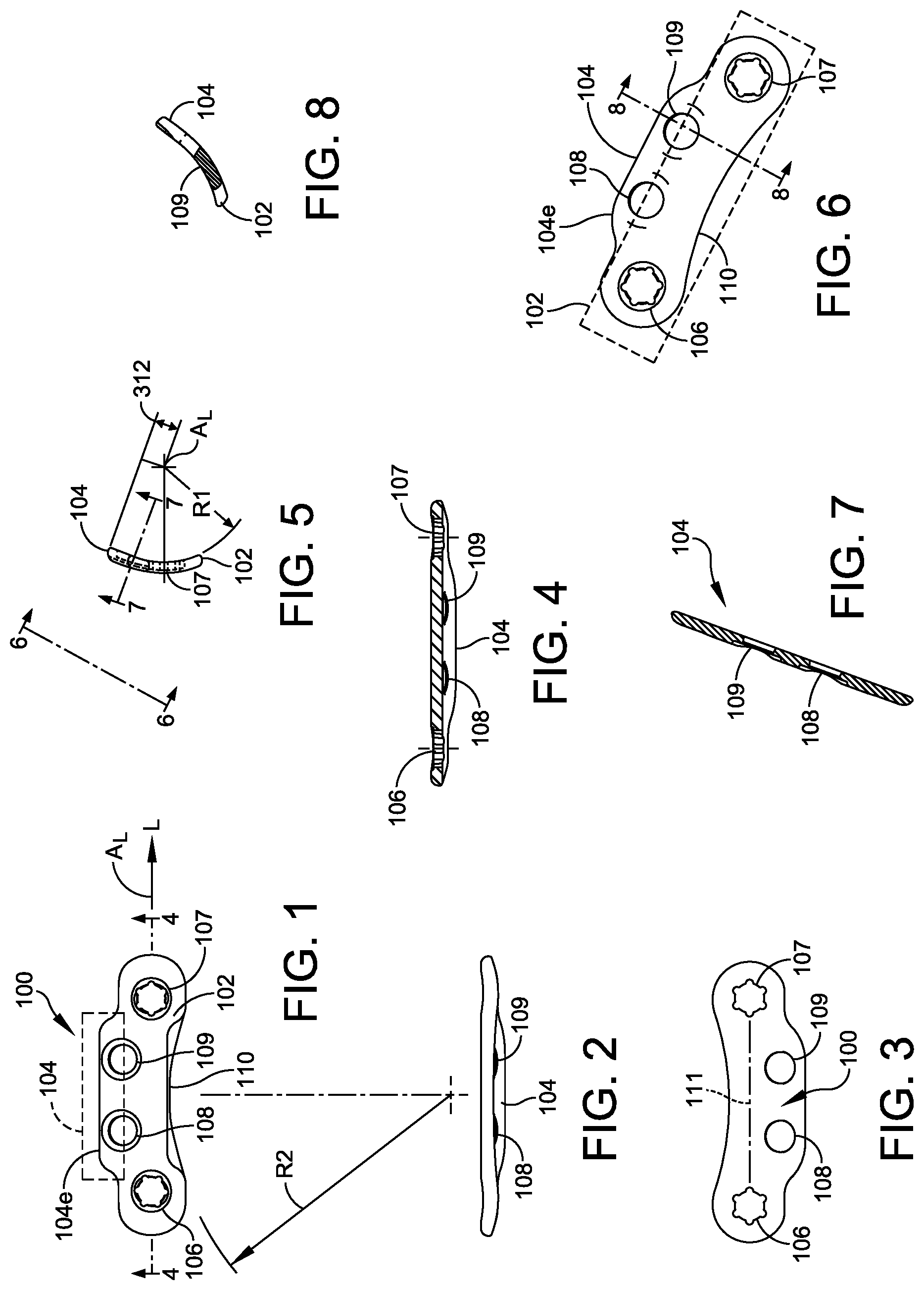 Patent US12350164 — Implant and method for ankle syndemosis treatment — Figure 1