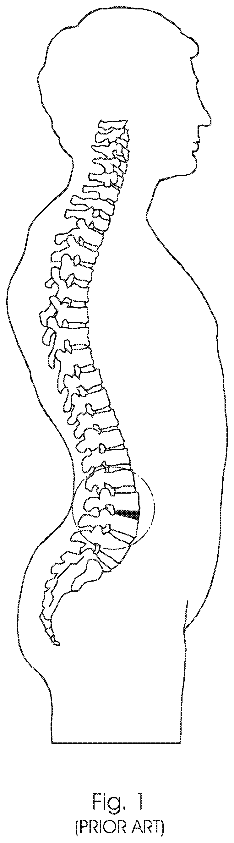 Patent US12350168 — Intervertebral fusion cage — Figure 1
