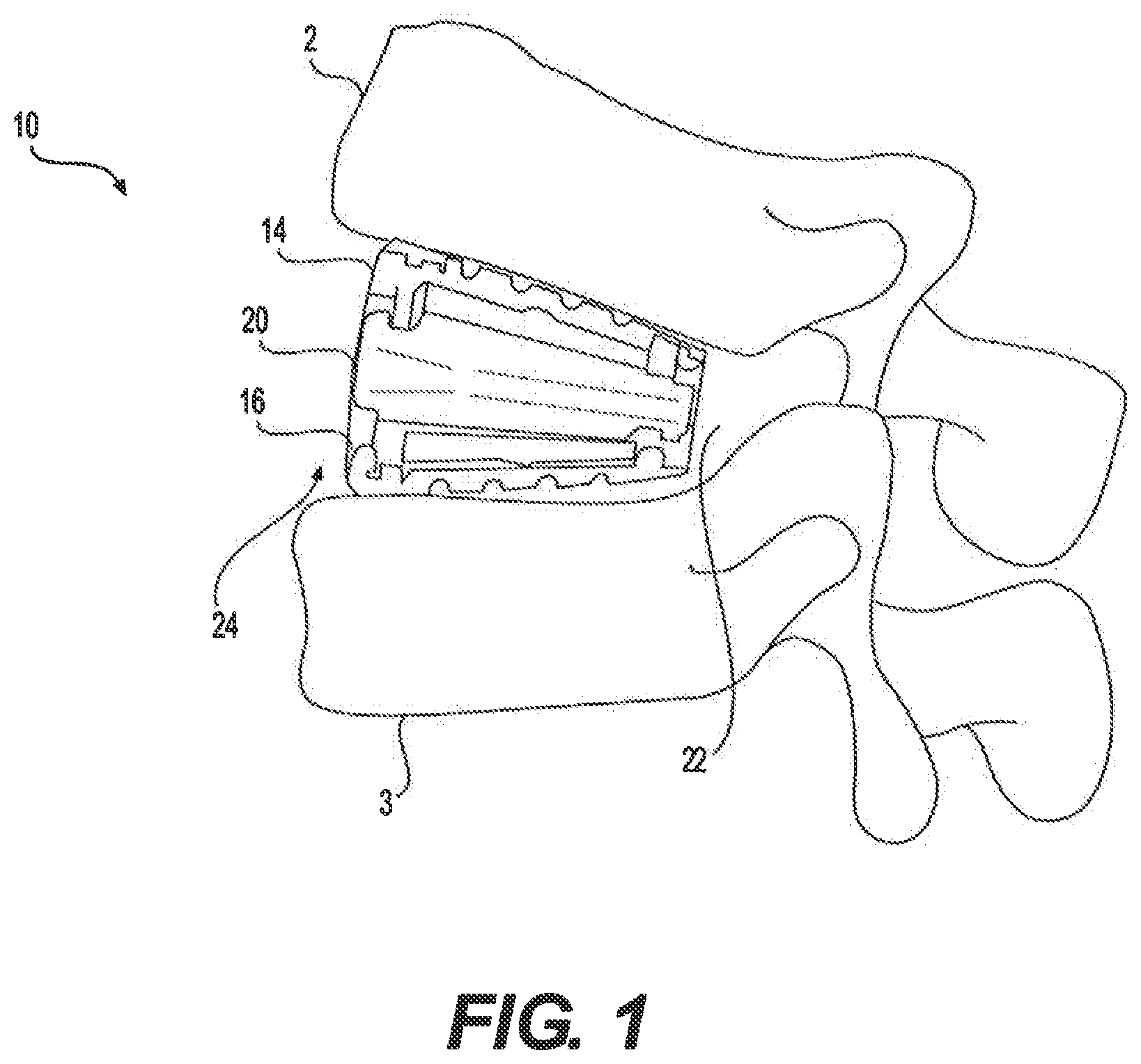 Patent US12350171 — Variable lordosis spacer and related methods of use — Figure 1