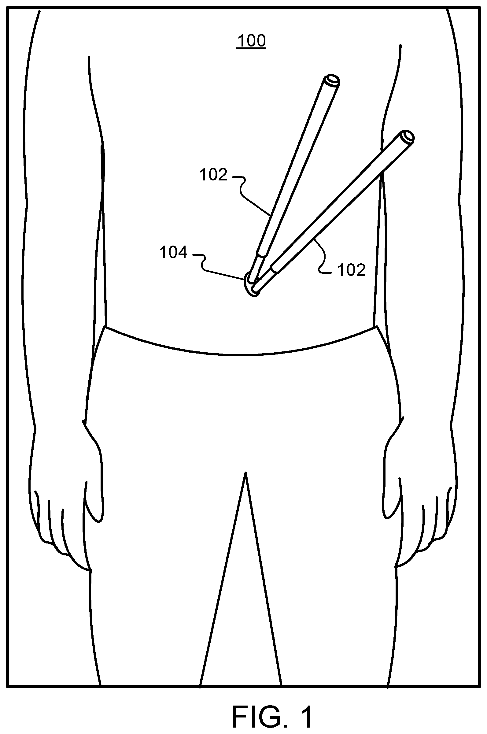 Patent US12350396 — Composite positive and negative Poisson's ratio tissue adhesives — Figure 1