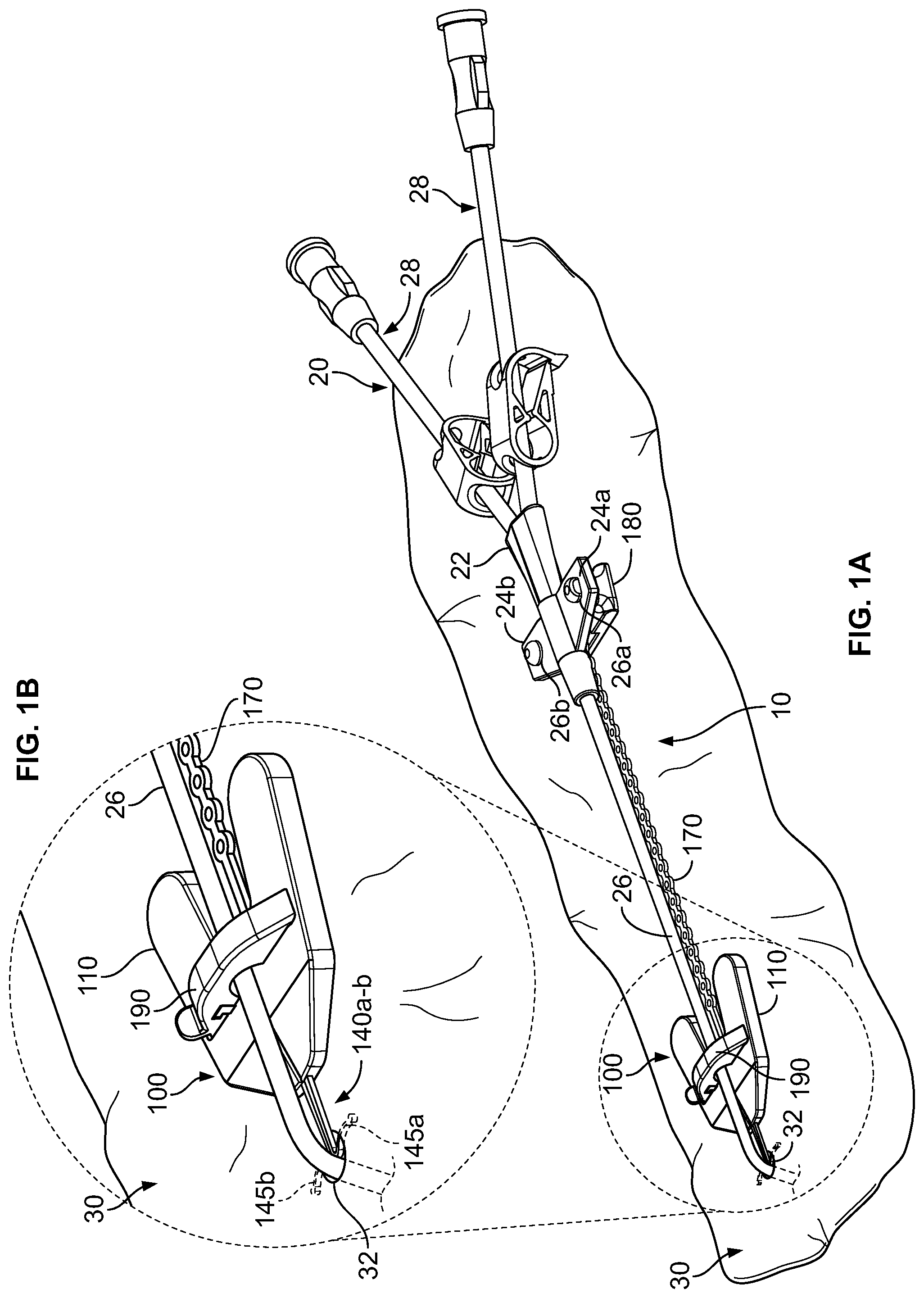 Patent US12350451 — Systems and methods for anchoring medical devices — Figure 1
