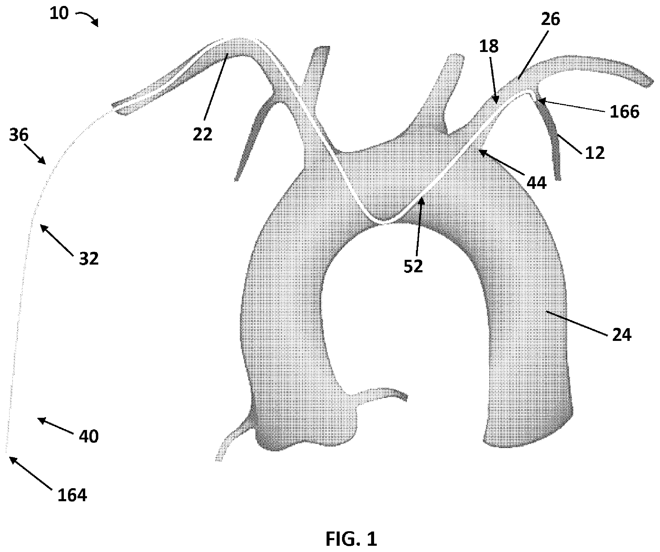 Patent US12350454 Figure 1 – LIMA crossover integrated catheter system