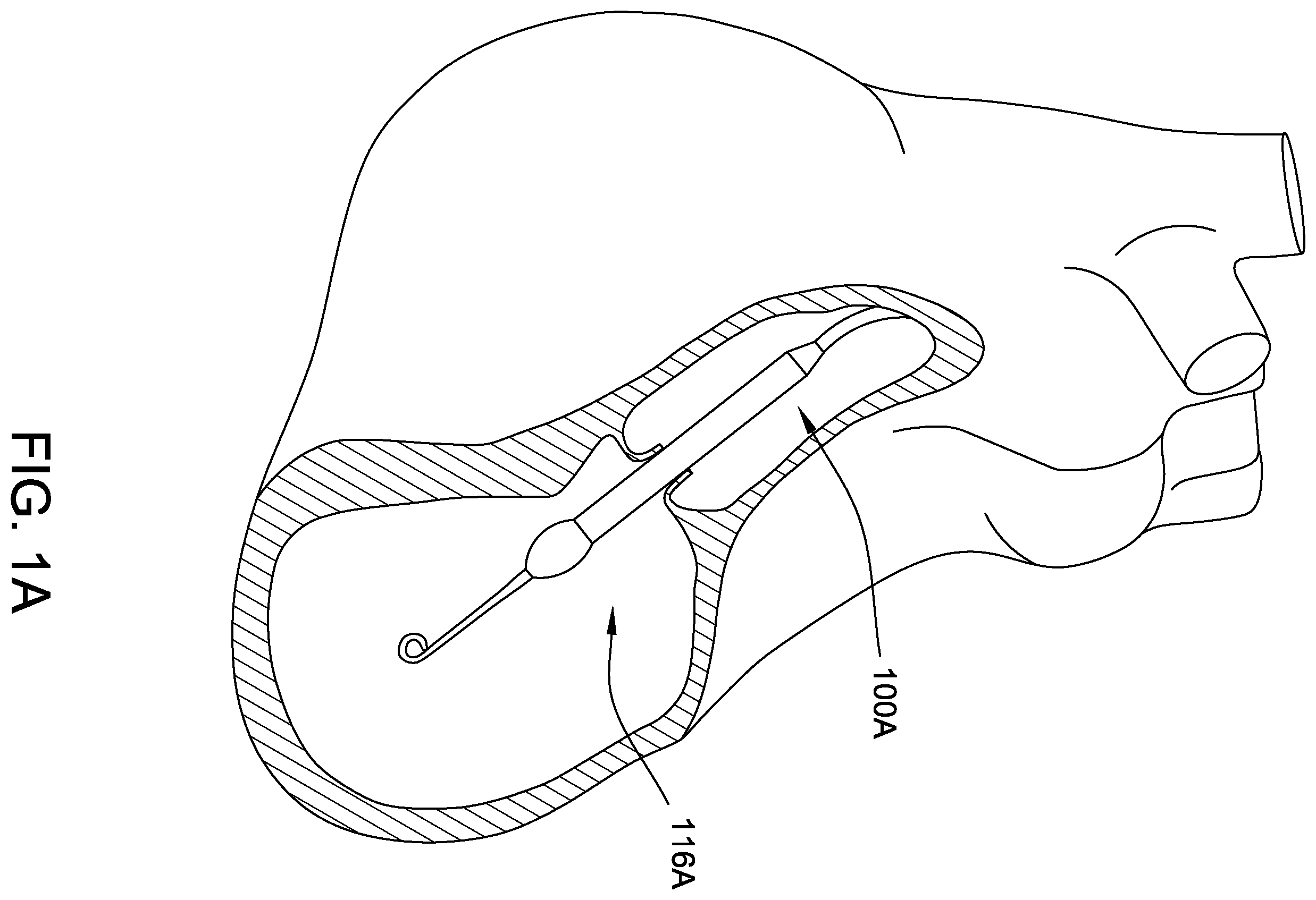Patent US12350483 — Fluid seals for catheter pump motor assembly — Figure 1