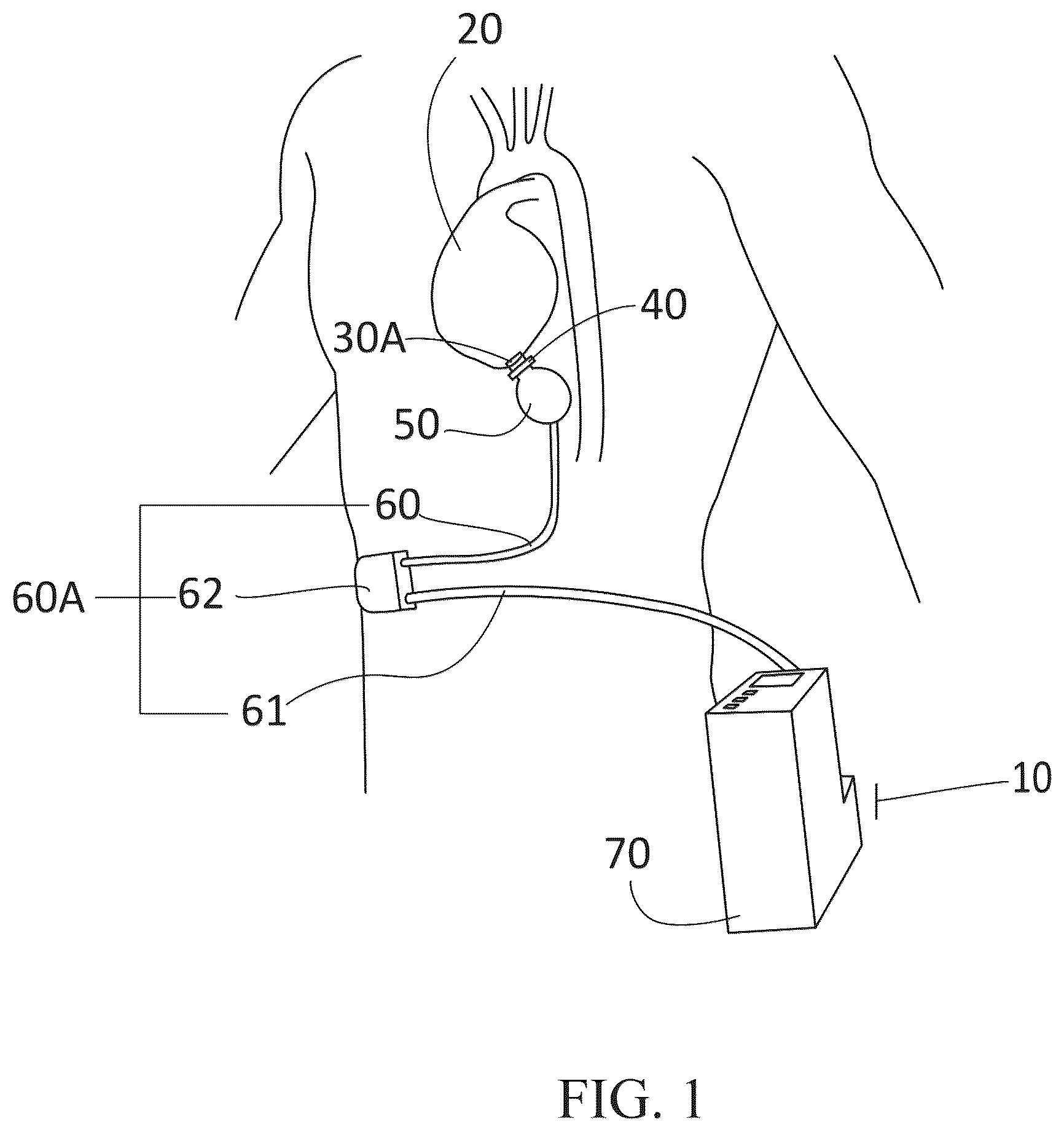 Patent US12350484 — Implantable co-pulsatile epi-ventricular circulatory support system with sutureless flow cannula assembly — Figure 1