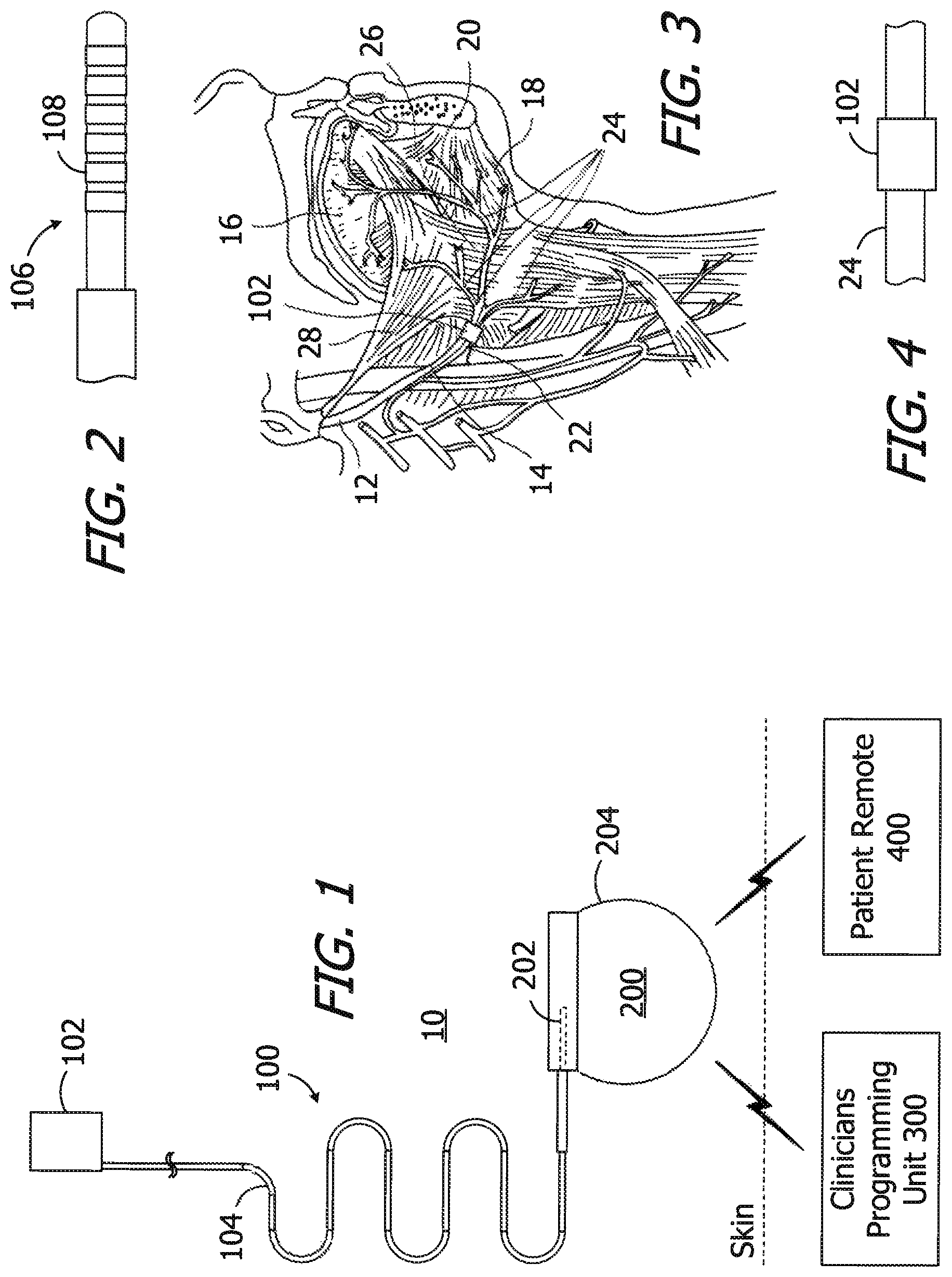 Patent US12350489 — Electrode leads having nerve cuffs and associated systems and methods — Figure 1