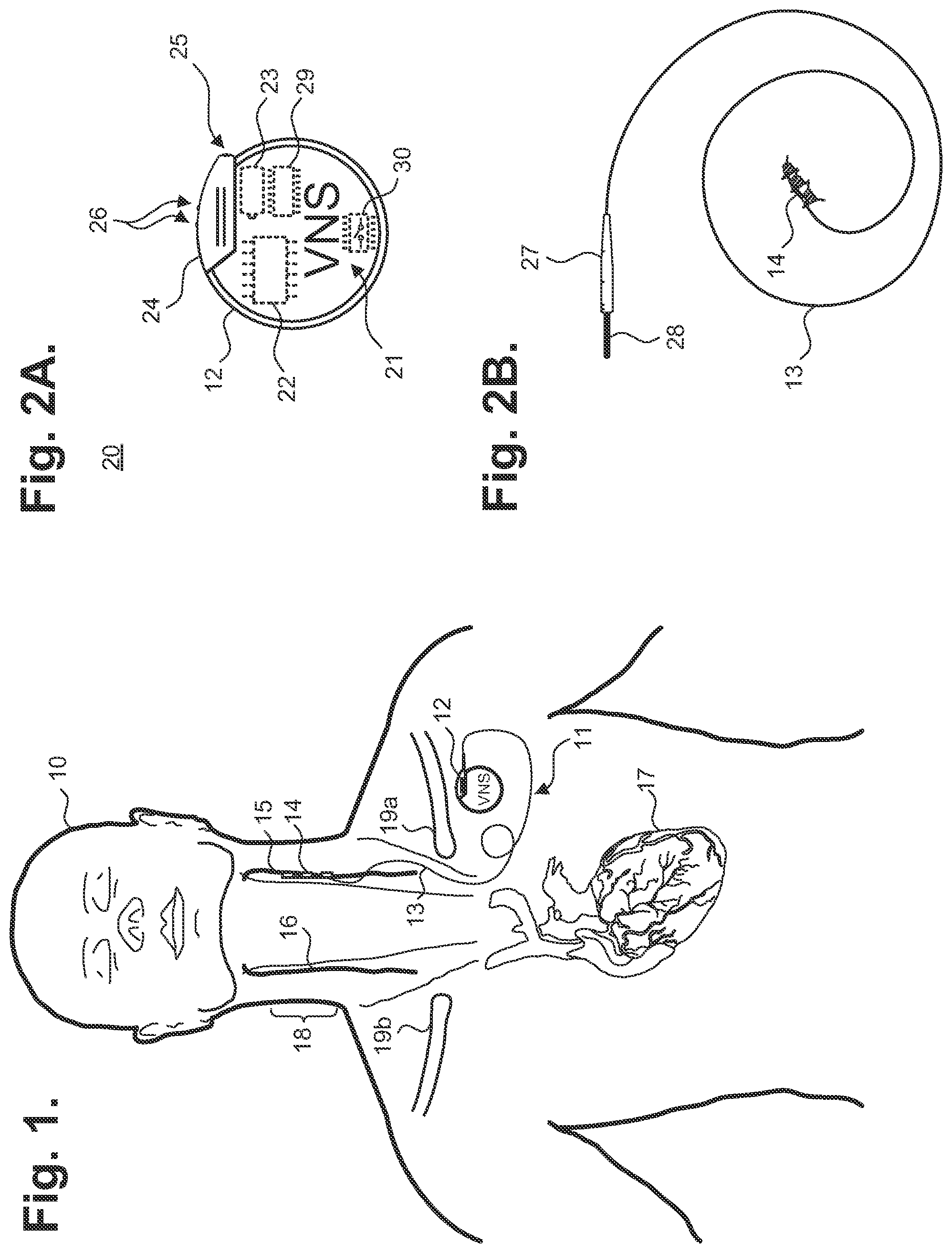 Patent US12350496 — Implantable neurostimulator-implemented method for managing bradycardia through vagus nerve stimulation — Figure 1