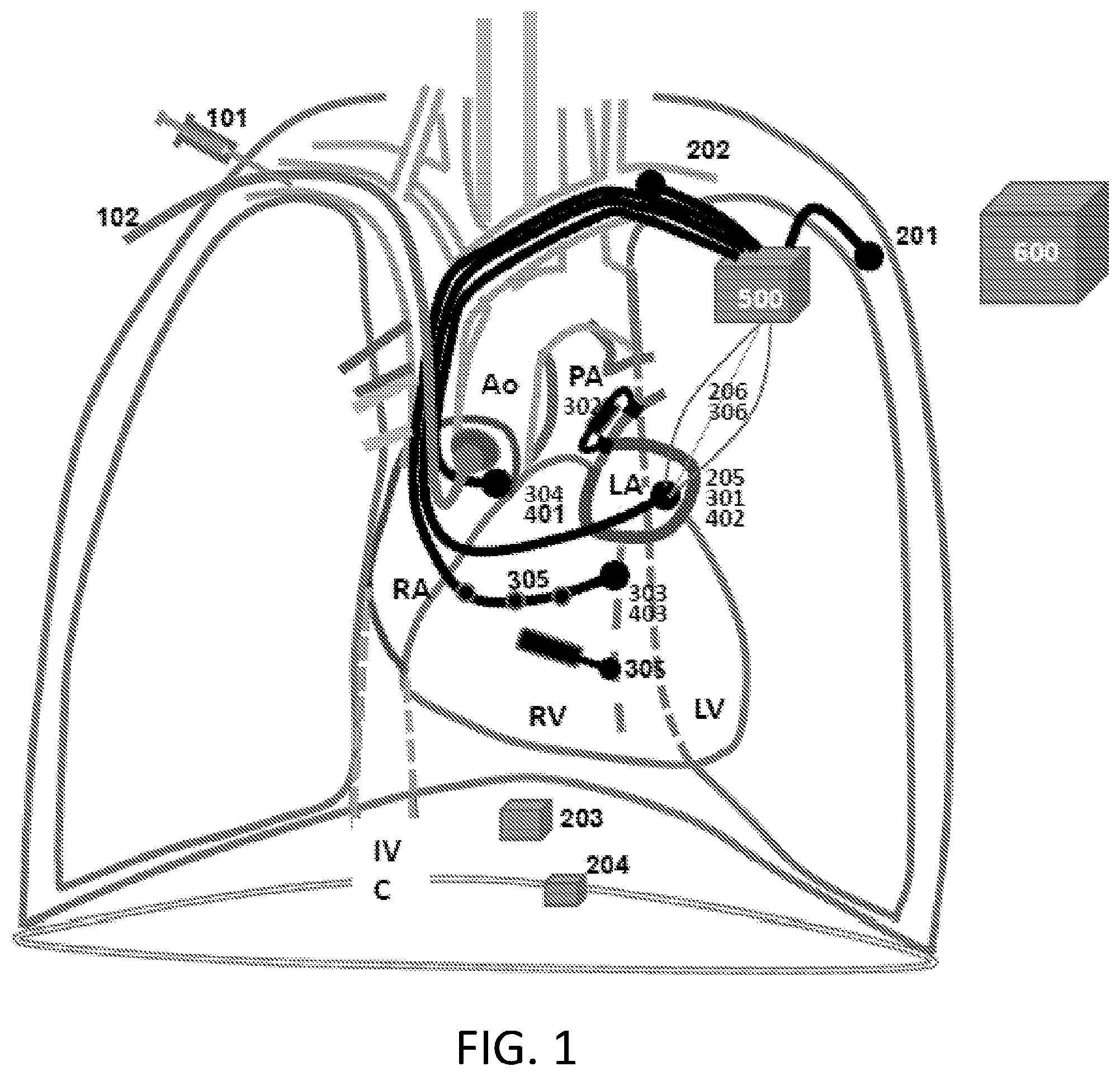 Patent US12350498 — Treatment of cardiac decompensation, pulmonary congestion and dyspnea — Figure 1