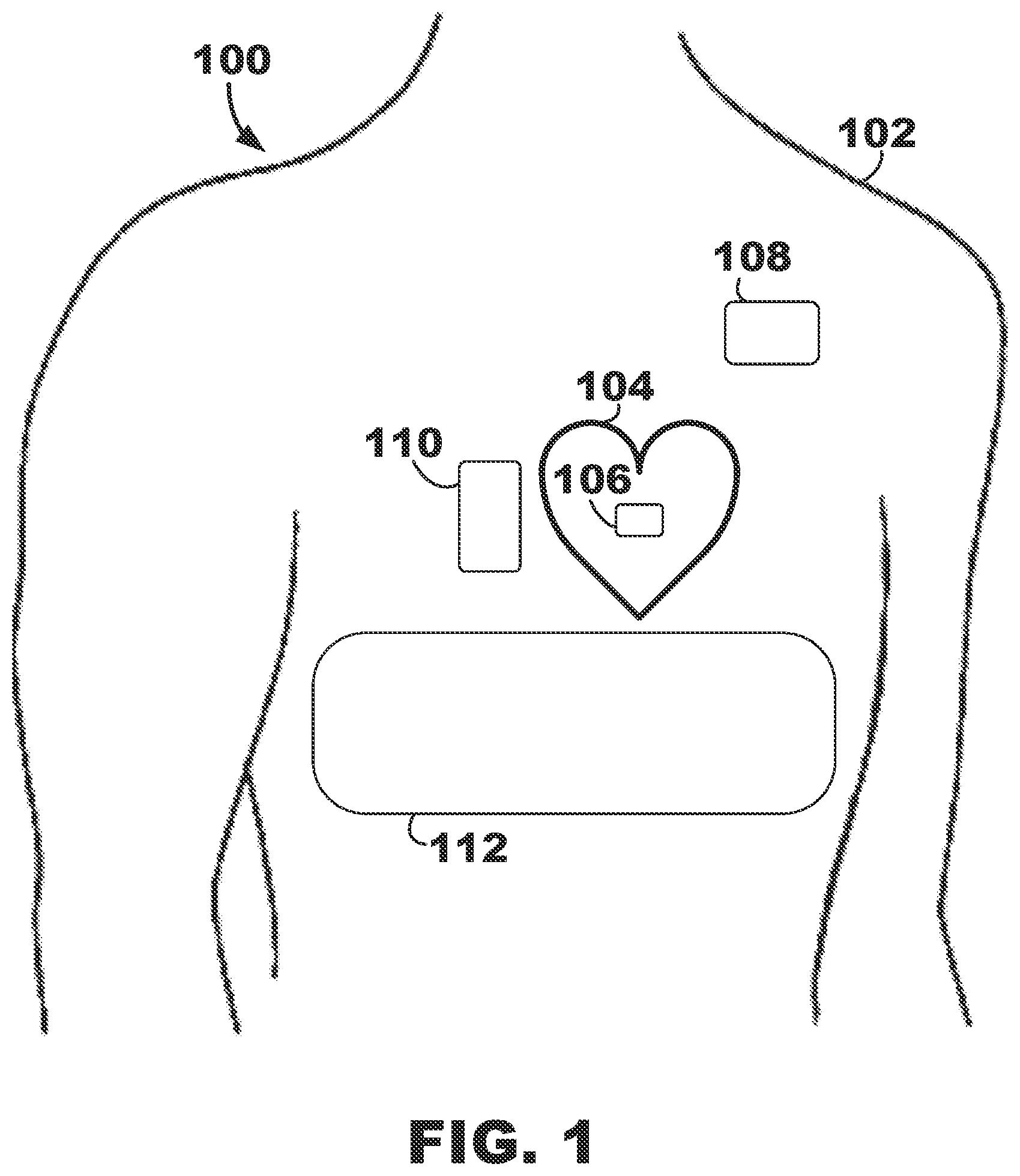 Patent US12350500 — AV synchronous septal pacing — Figure 1