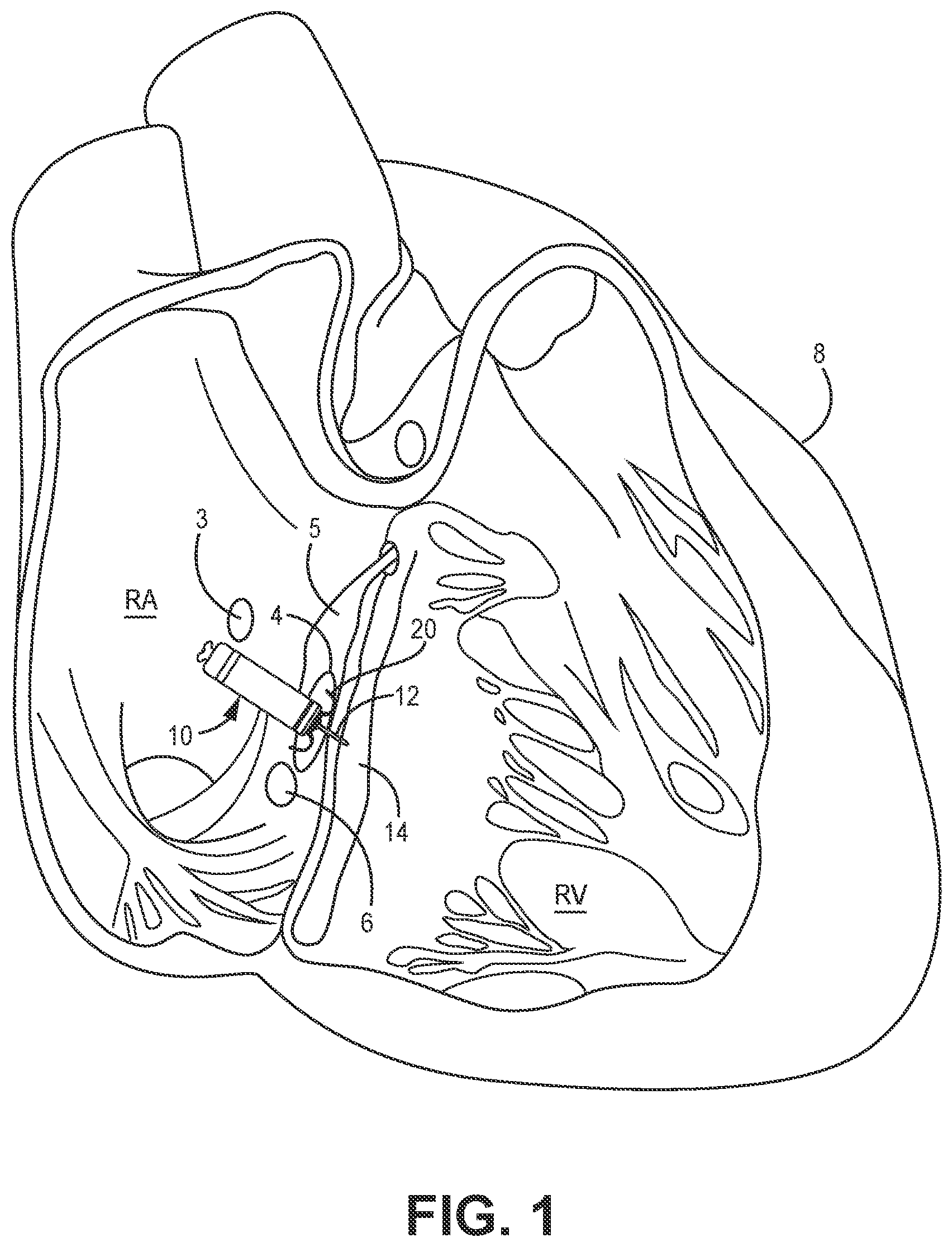 Patent US12350502 — Electrodes for intra-cardiac pacemaker — Figure 1